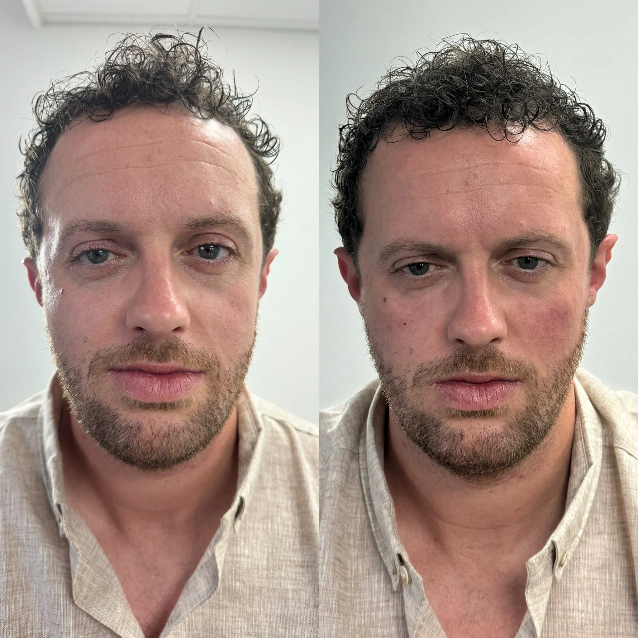 Before and after results of UKALM Masculinization treatment with Dermal Fillers.