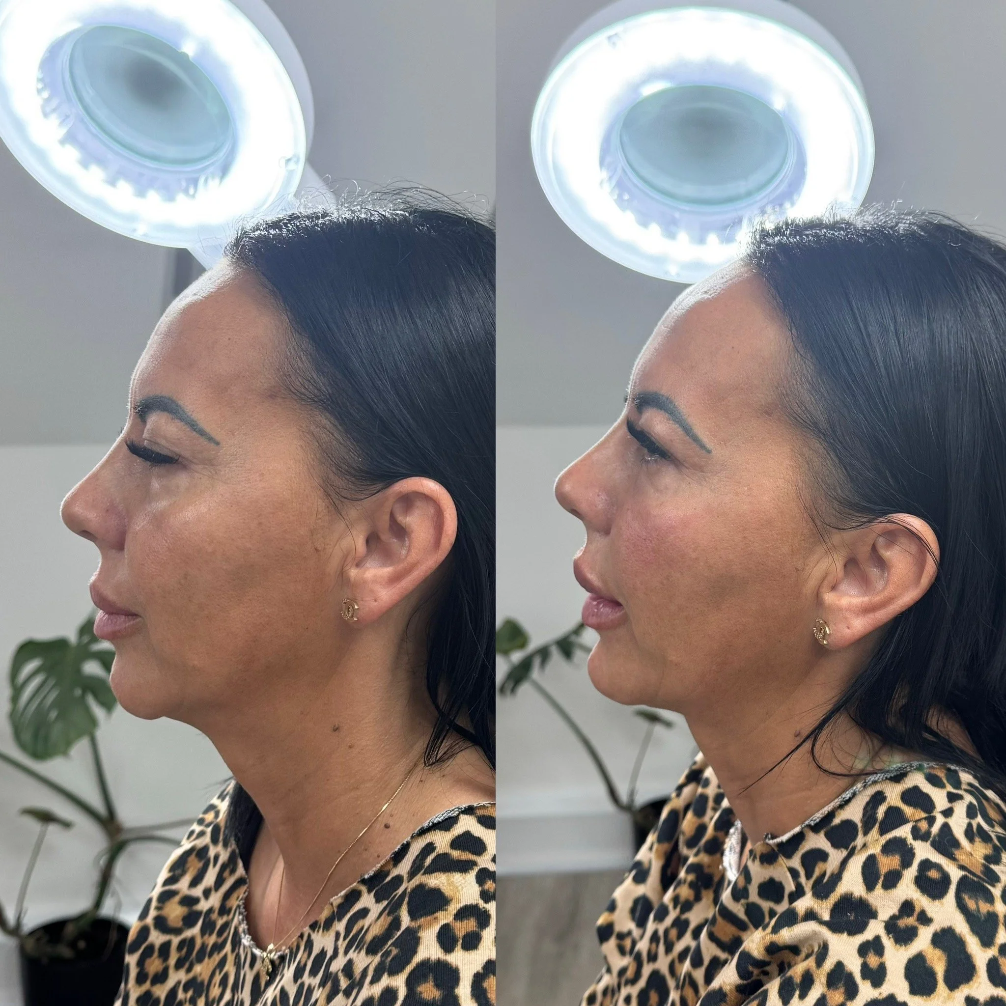 Before and after of a woman having a Dermal Filler treatment at UKALM with 3mL's of Dermal Filler in UKALM for profiling, the best Aesthetic Clinic in London with the best Lip filler, Chin Filler & Cheek Contouring with Filler.