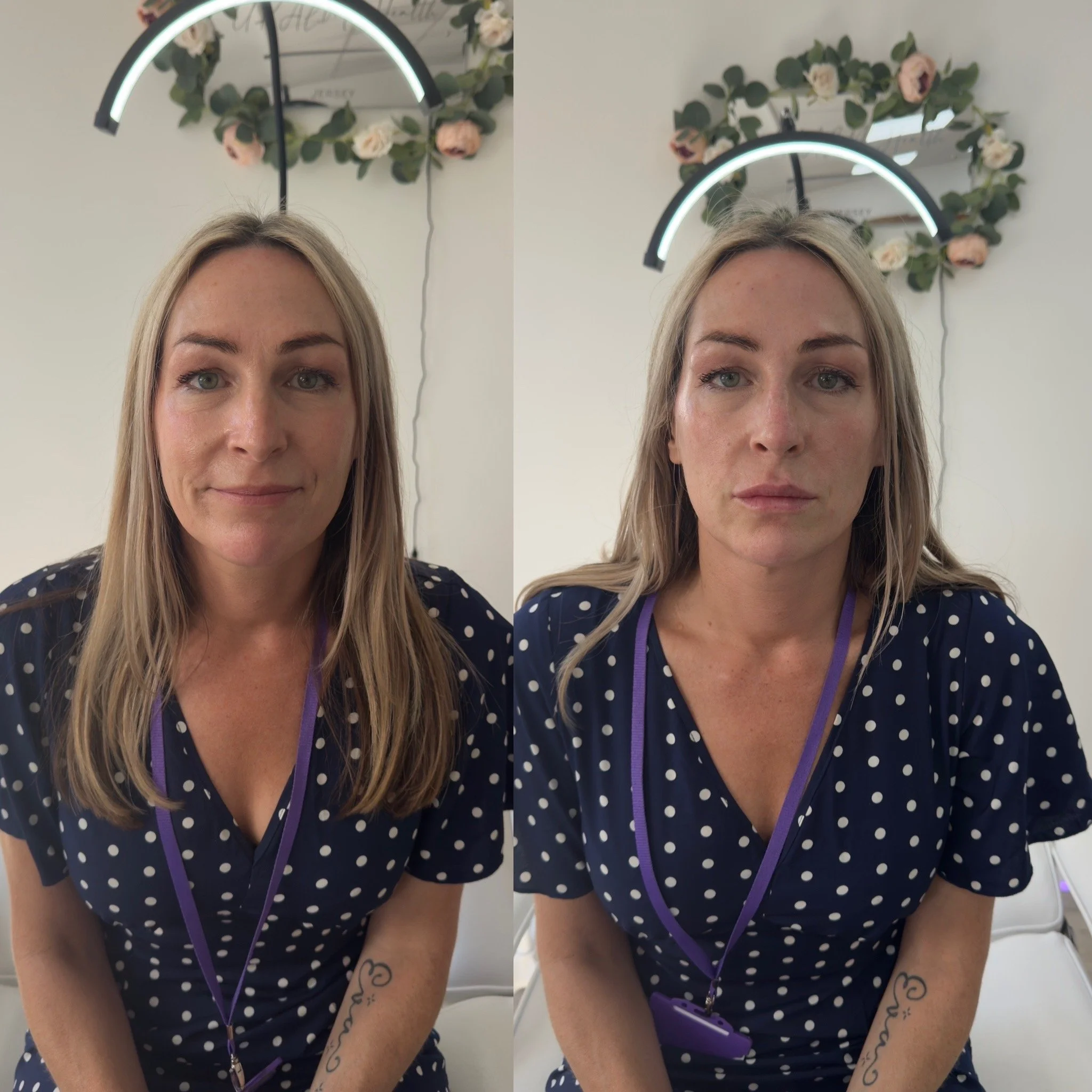 Before & After of 4mL Beautification Treatment in a woman at UKALM Clinics using only 3.5mLs of Dermal Filler for sculpted aesthetic with cheek, chin, nose & Lip filler.
