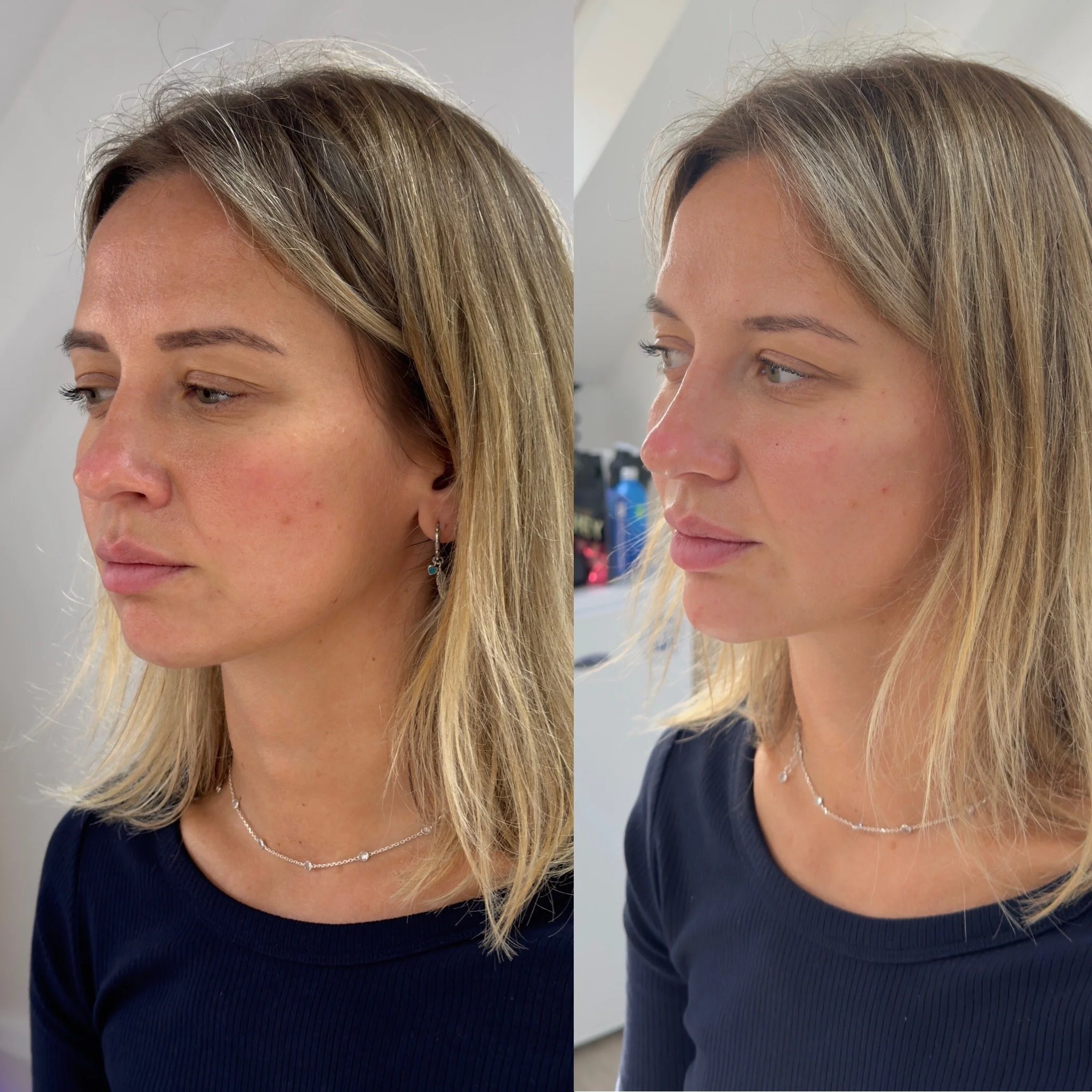 Before and after results of UKALM Profiling with Dermal Fillers.
