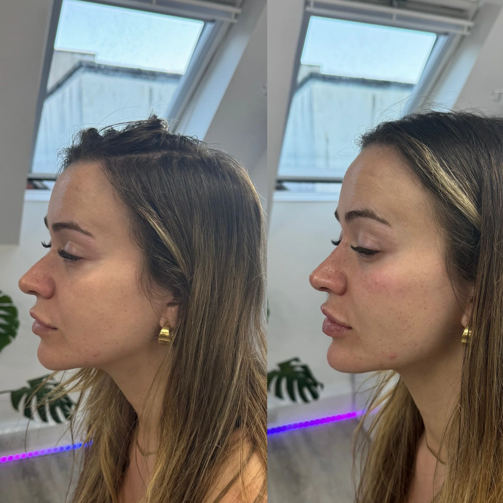 Side profile view of 3mL Dermal Filler Treatment for Chin Filler & Profiling at UKALM