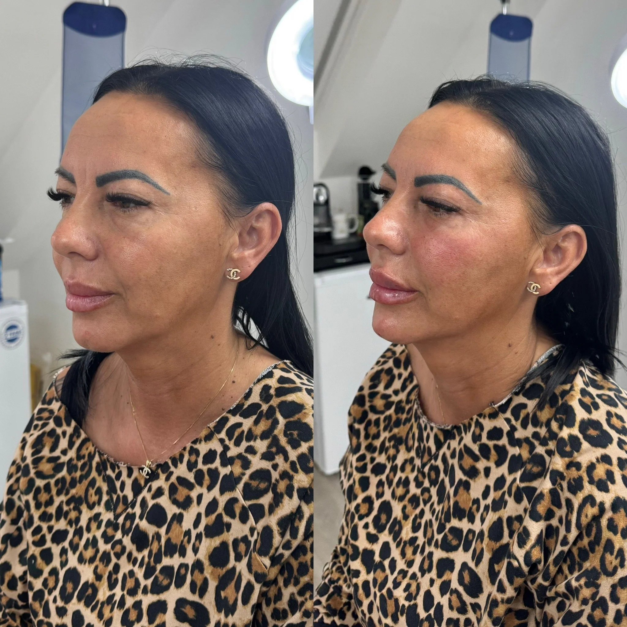 Profiling treatment before and after a Dermal Filler treatment at UKALM with 3mL's of Dermal Filler in UKALM for profiling, the best Aesthetic Clinic in London with the best Lip filler, Chin Filler & Cheek Contouring with Filler.