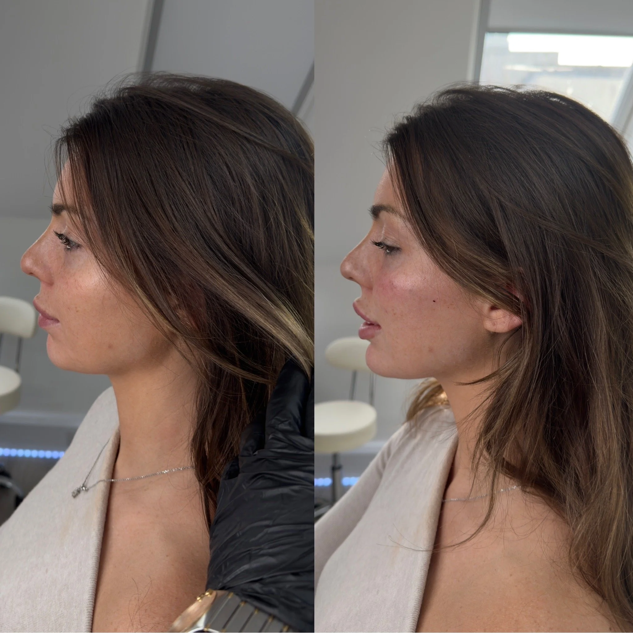 Side view of Facial Profiling results of 3mLs Dermal filler to balance the cheeks & profile the lips, chin & nose