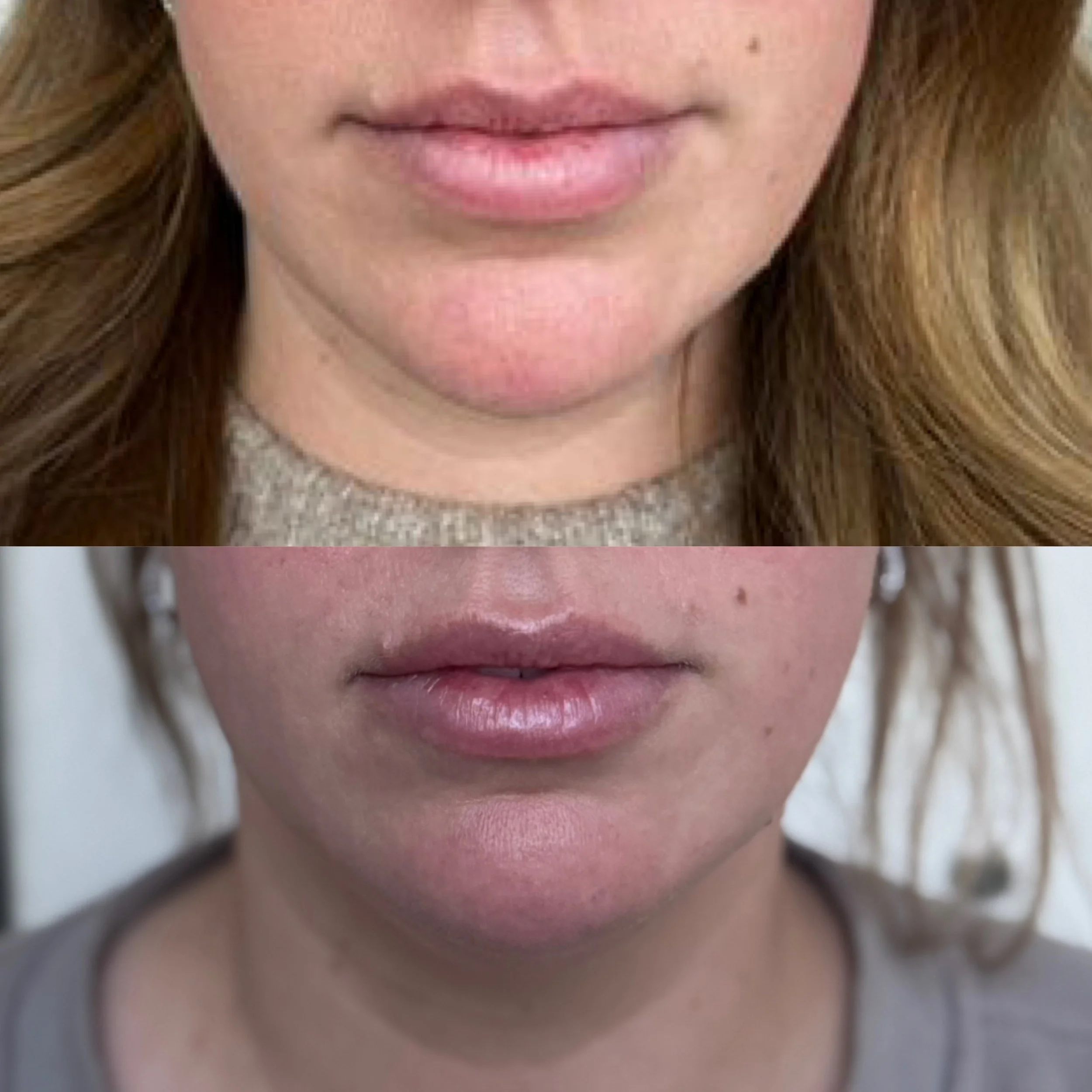 Close-up comparison of two women's lips and lower faces, one with natural pink lips and the other with slightly parted lips showing natural lip lines.