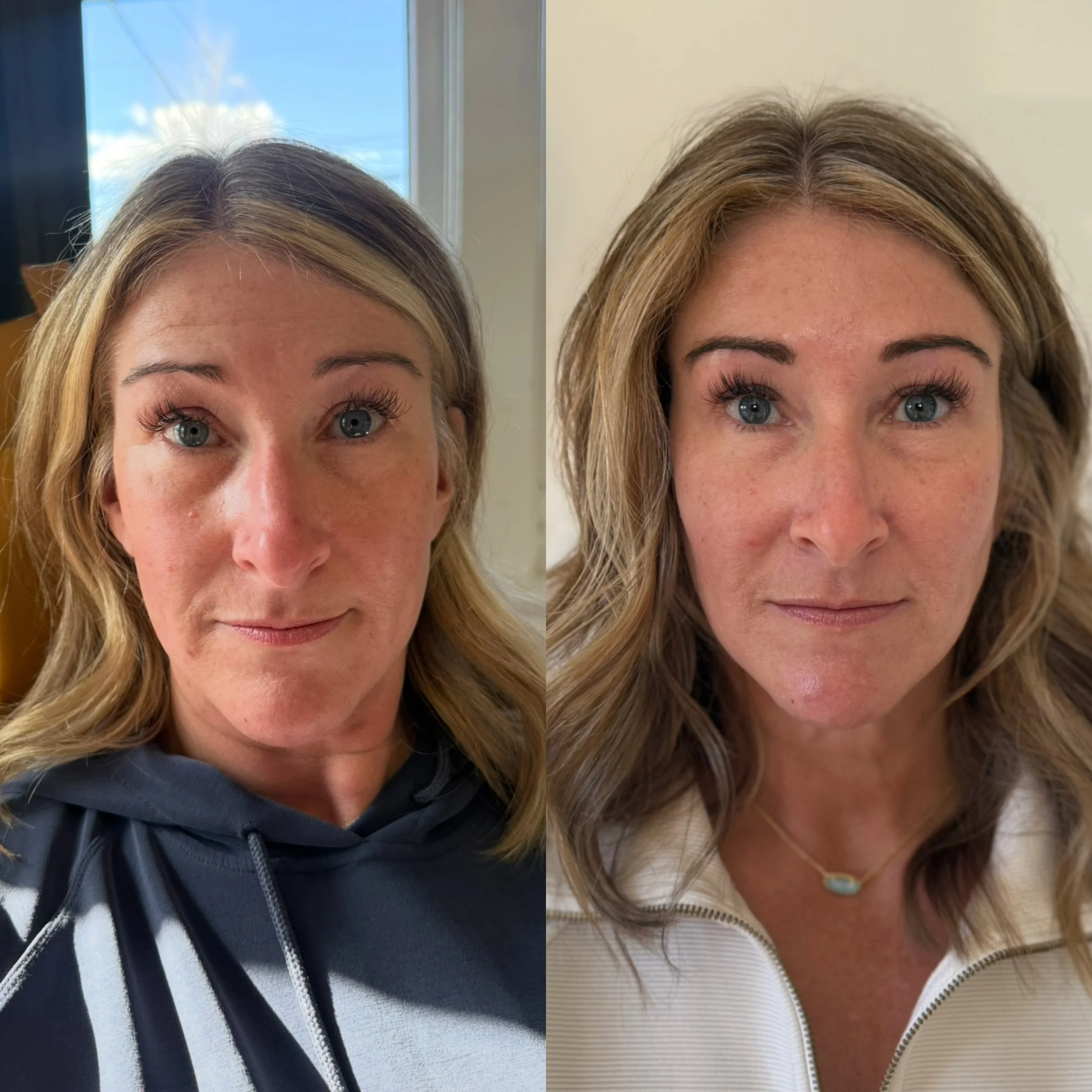 Side-by-side comparison of a woman before and after a skincare transformation.