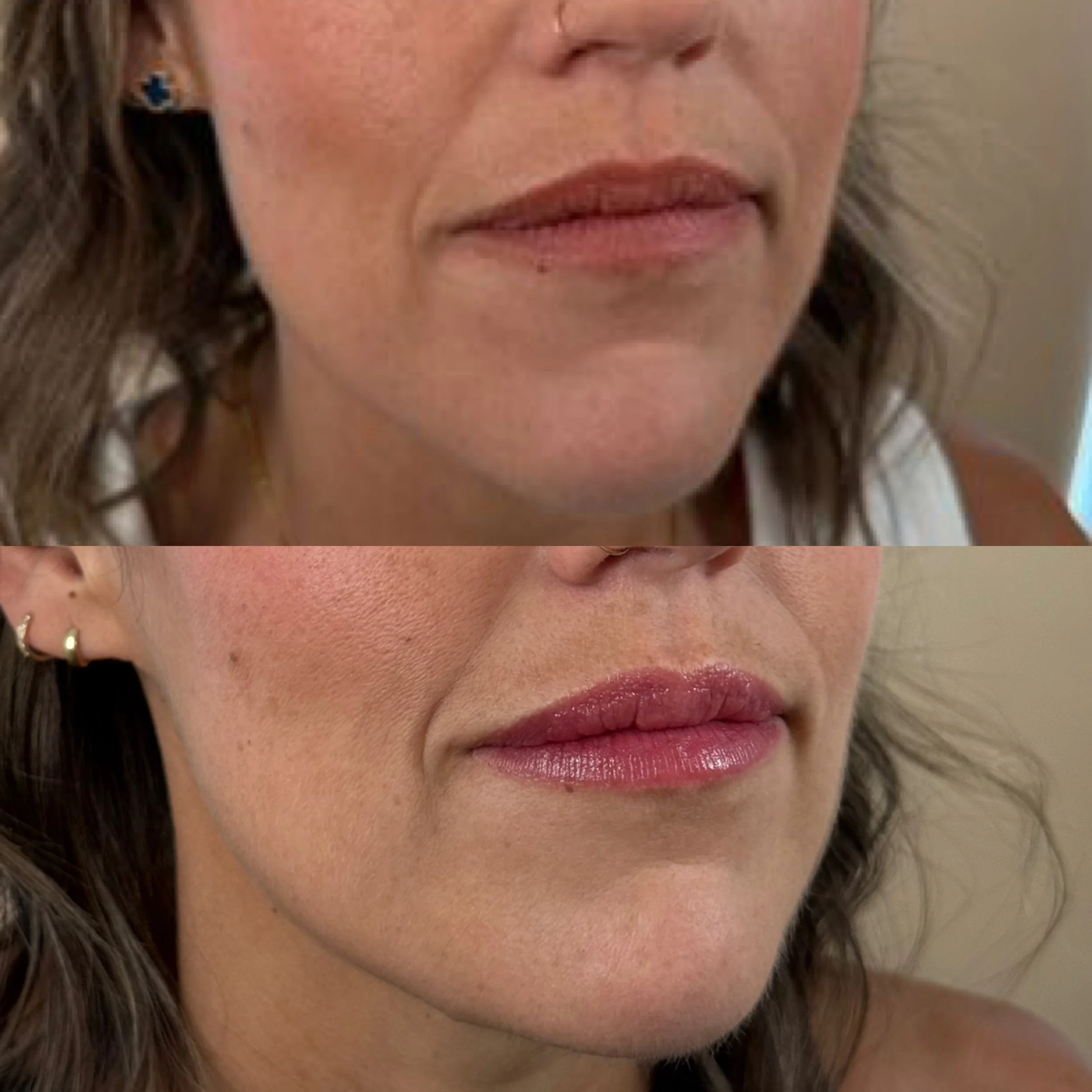 Close-up of a woman's lips before and after cosmetic lip enhancement, showing improvement in lip fullness and shape.