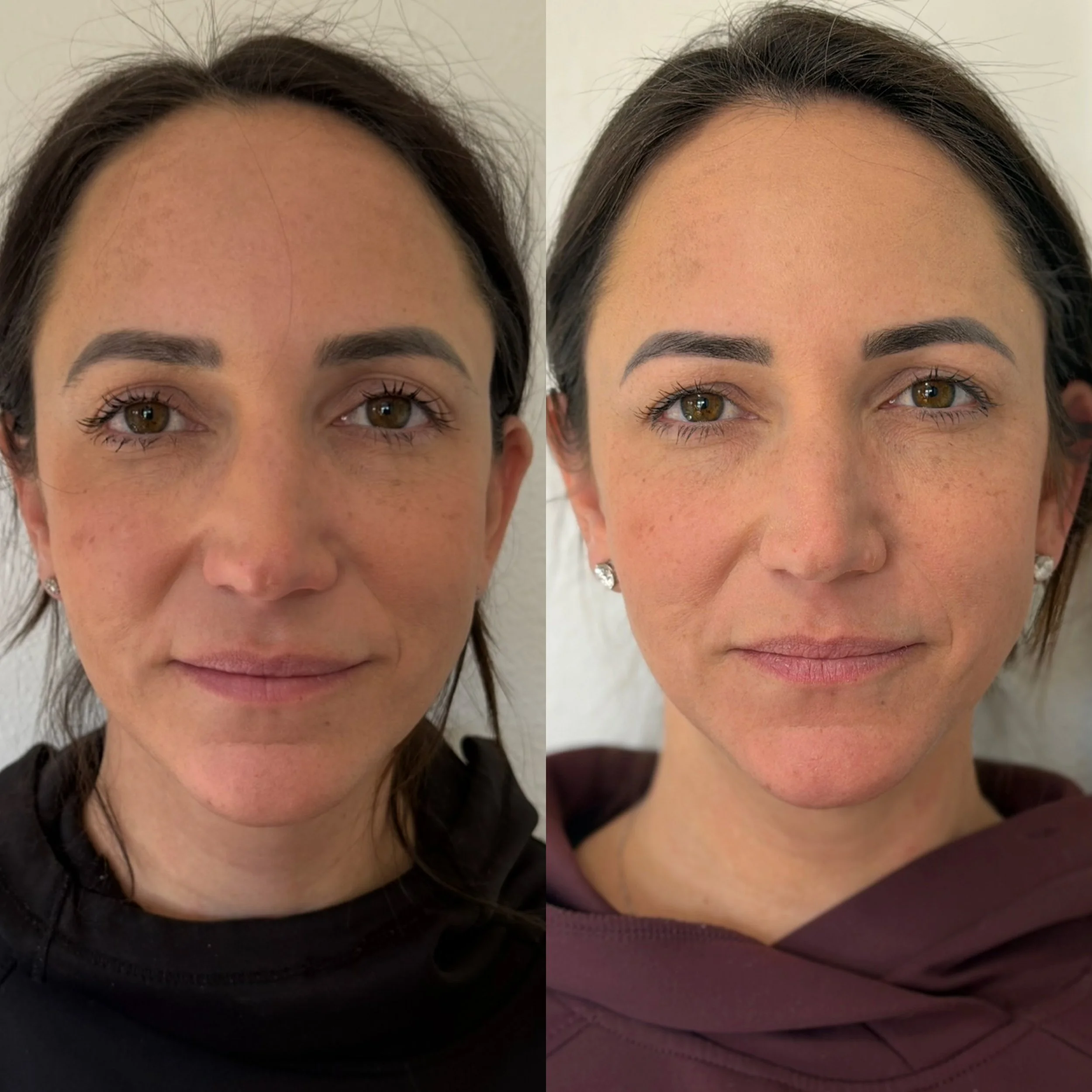 Comparison of a woman before and after cosmetic treatment, showing a reduction in facial wrinkles and freckles, with improved skin smoothness and tone.