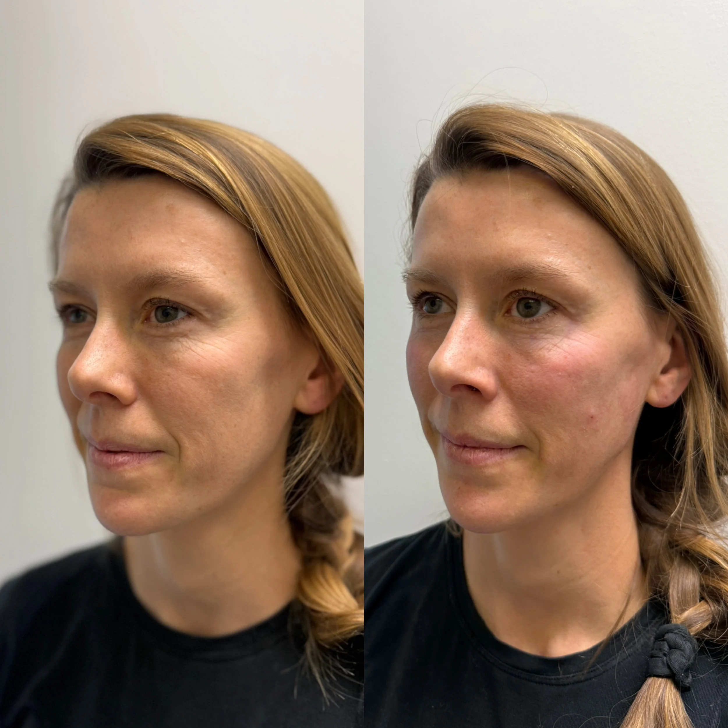 Comparison of a woman's face before and after skincare, showing smooth skin with minor blemishes on the right.