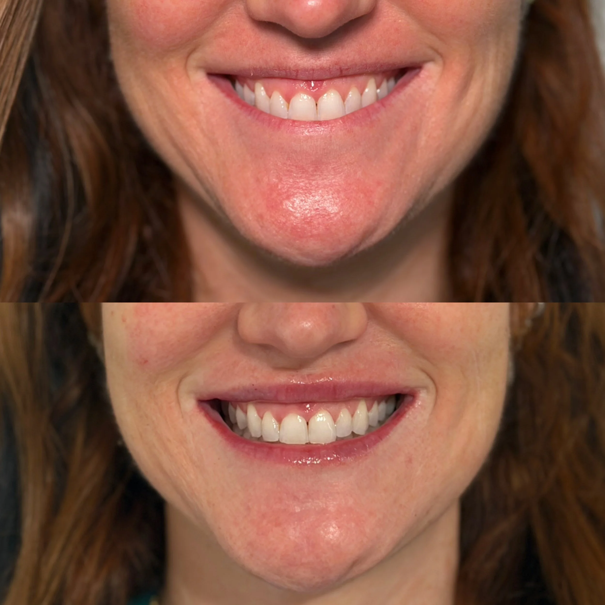 Close-up of a woman's smiling mouth, showing her teeth and tongue, with minor skin imperfections and red hair.