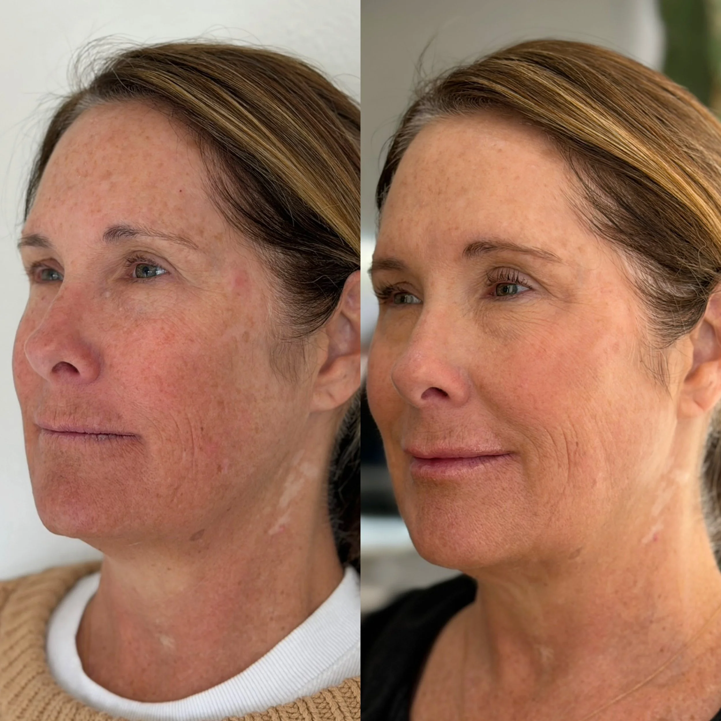 Side-by-side comparison of a woman's face before and after skincare treatment, showing clear skin and reduction of redness and freckles.