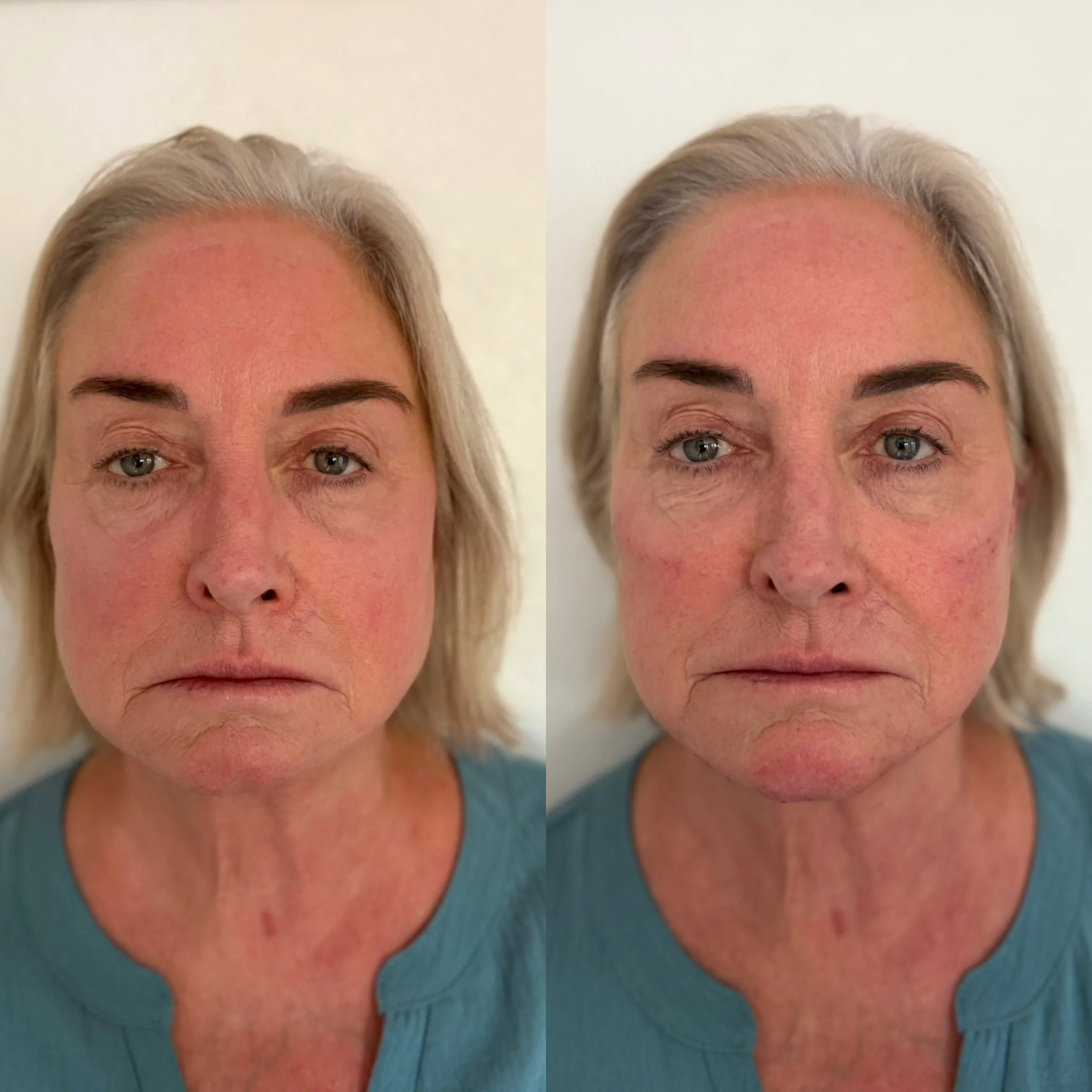 Close-up of a middle-aged woman with shoulder-length blonde hair, showing a side-by-side comparison of her face before and after a skincare treatment, in a well-lit room with a plain light-colored background.