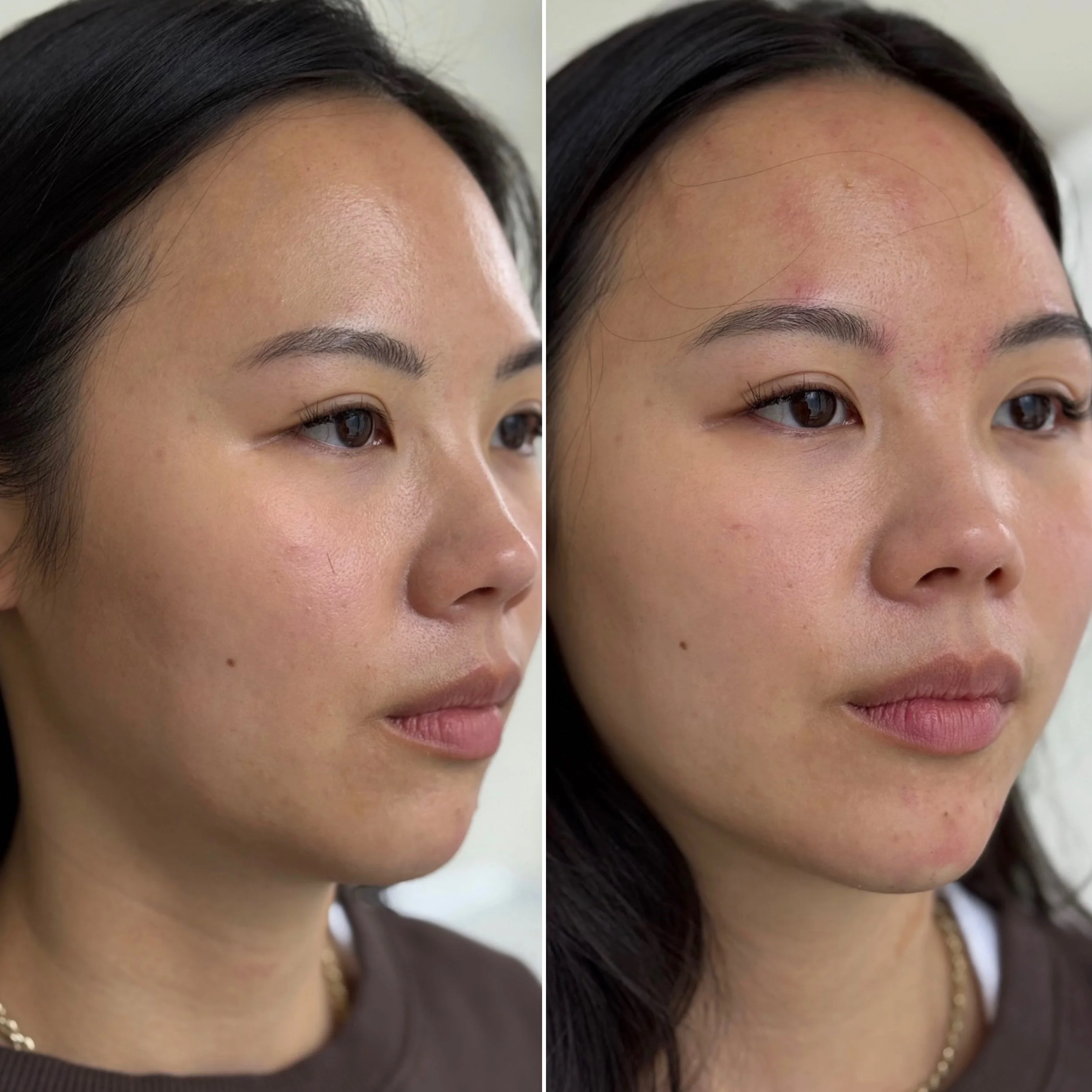 Close-up of a woman’s face showing her before and after skin treatment, with clear skin on the left and some redness and acne marks on the right.