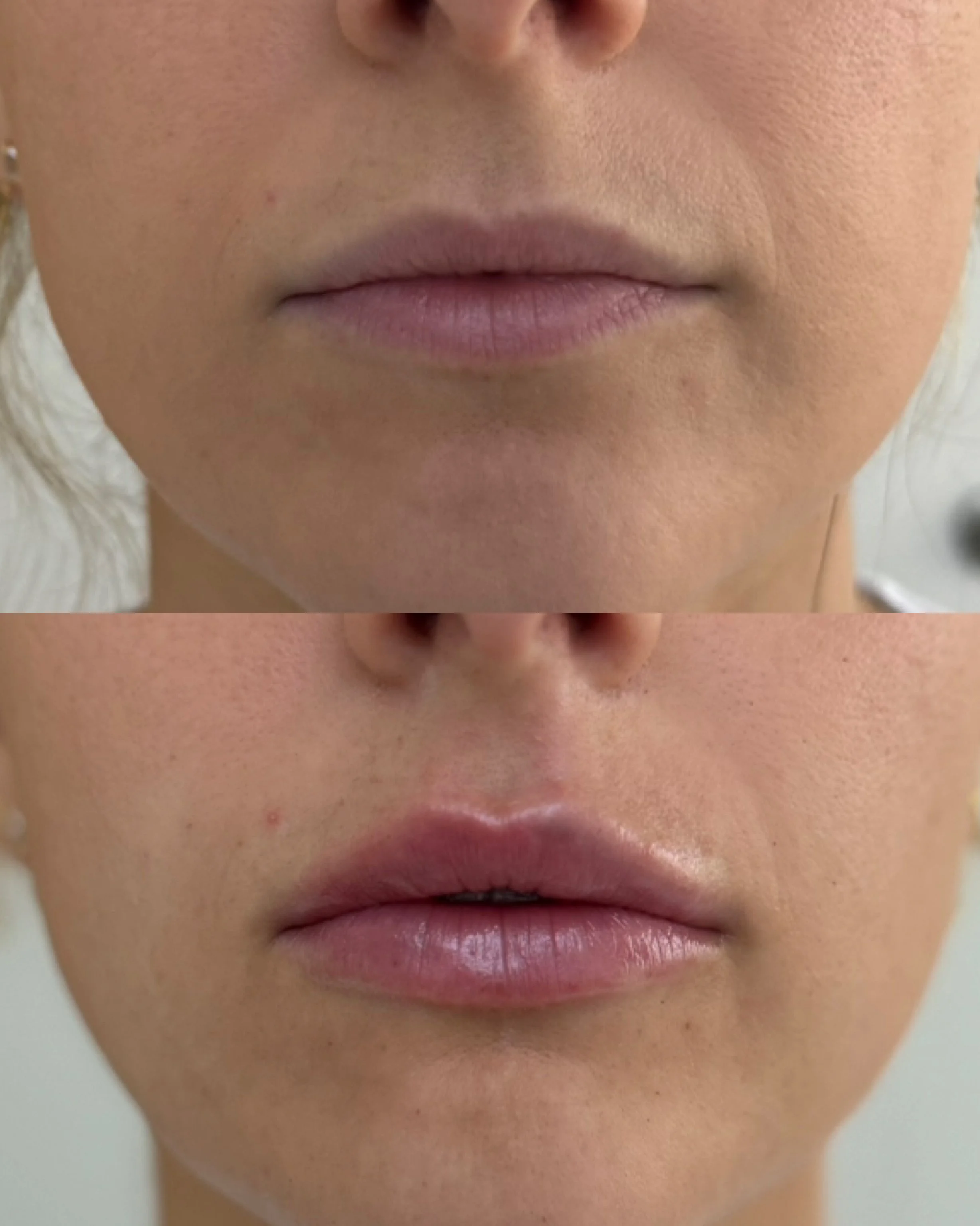 Close-up of a woman's lips before and after a cosmetic procedure, showing changes in lip volume and shape.