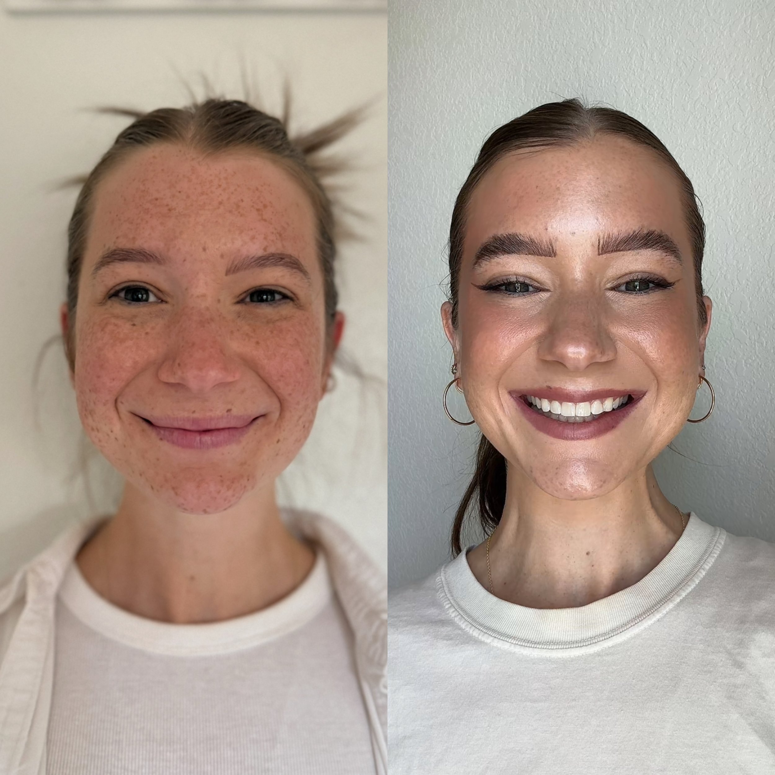 Comparison of a woman with freckles and acne on the left and clear, smooth skin on the right, smiling in both photos.