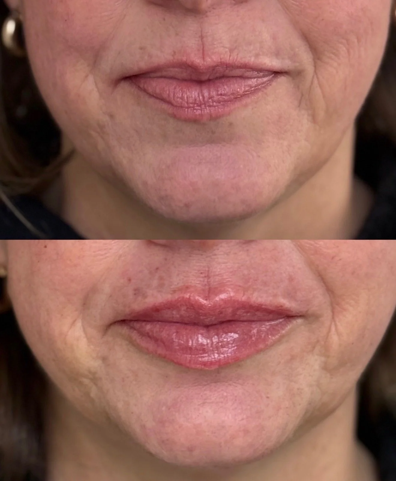 Close-up of a person's lips before and after lip enhancement treatment.
