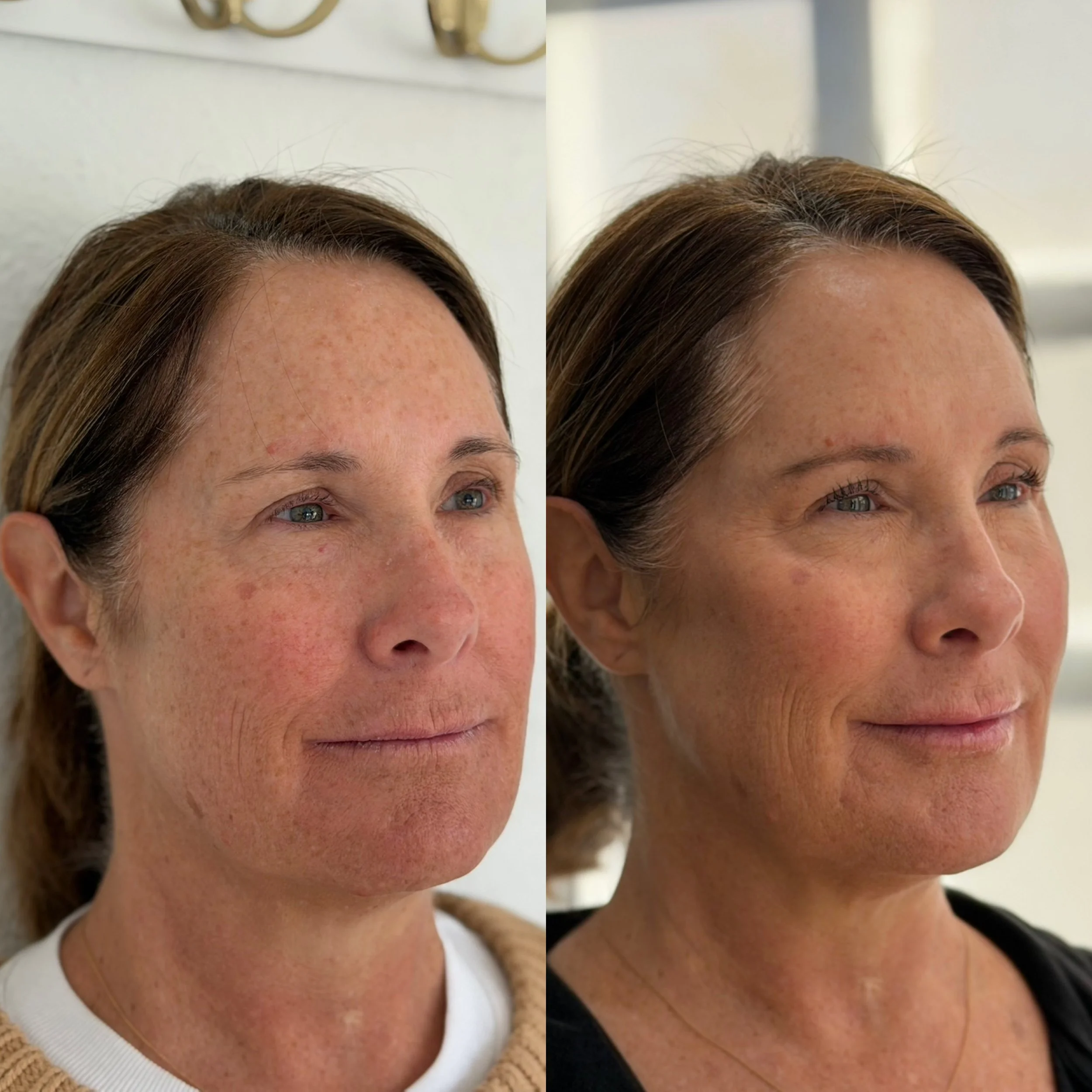 Before and after images of a woman with visible skin redness, freckles, and minor blemishes on the left, and clearer, more even-toned skin on the right.