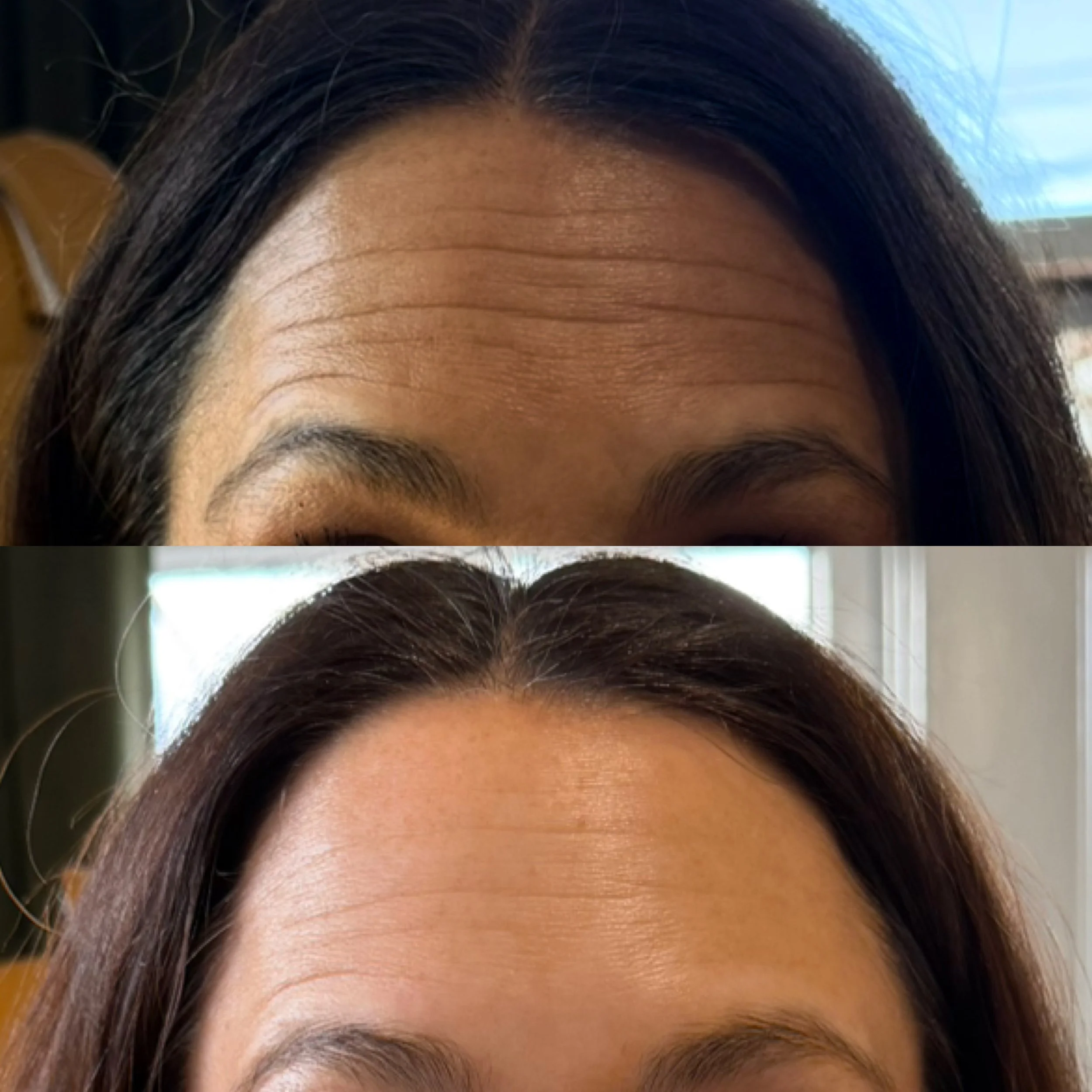 Comparison of a woman's forehead and hairline before and after skincare or cosmetic treatment. The top image shows more wrinkles and less smooth skin, while the bottom image shows smoother skin with fewer wrinkles.