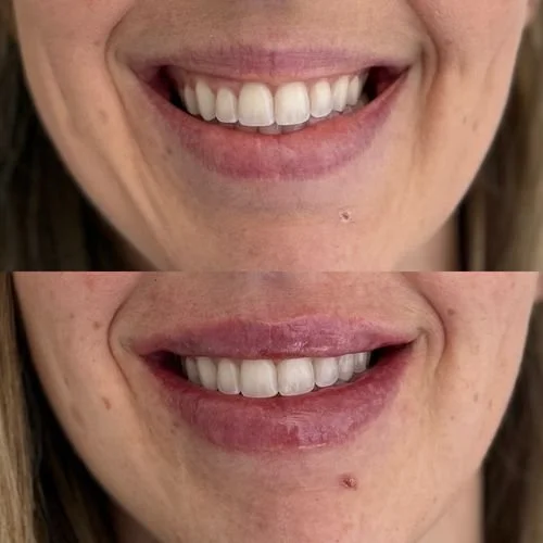 Close-up of a person's smile showing teeth and lips in two different images.