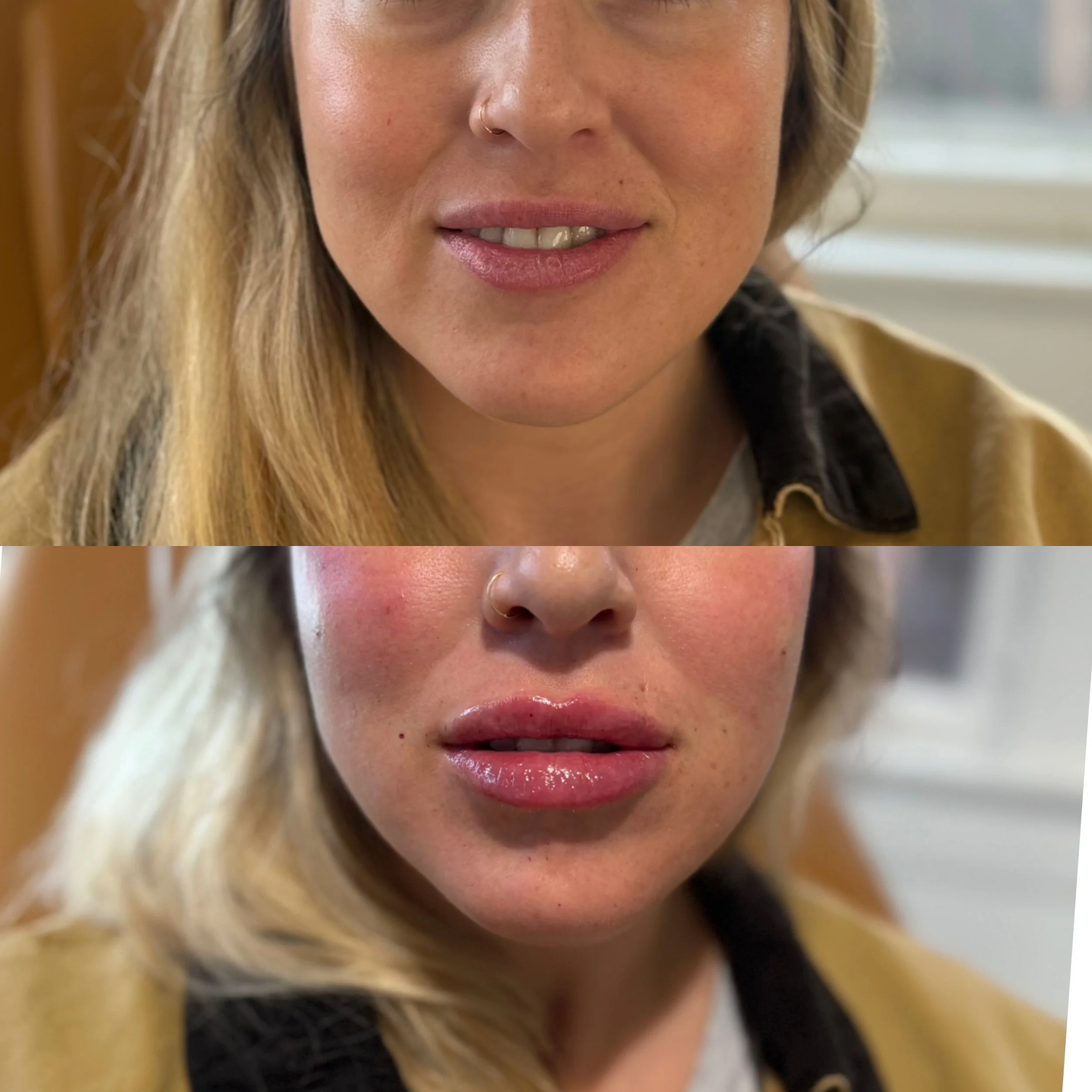 Close-up of a woman with blonde hair, showing before and after lip and cheek enhancements.