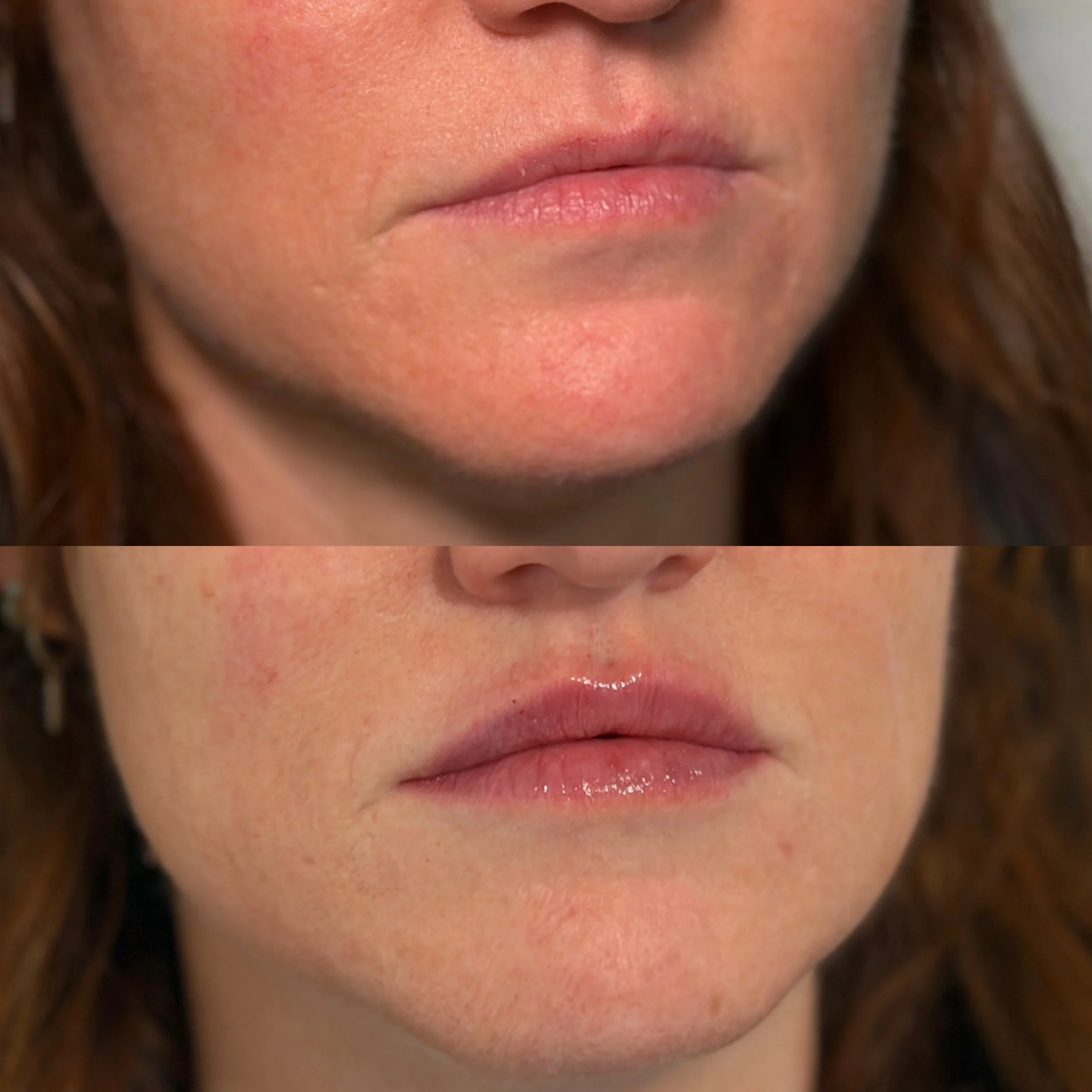 Close-up of a woman's face showing before and after a cosmetic lip treatment, with the after lips appearing fuller and glossy.