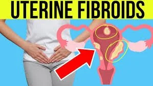 Fibroids… The friend you never wanted!