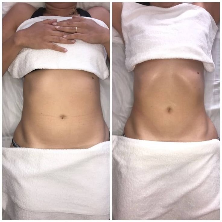 Lymphatic massage for bloating