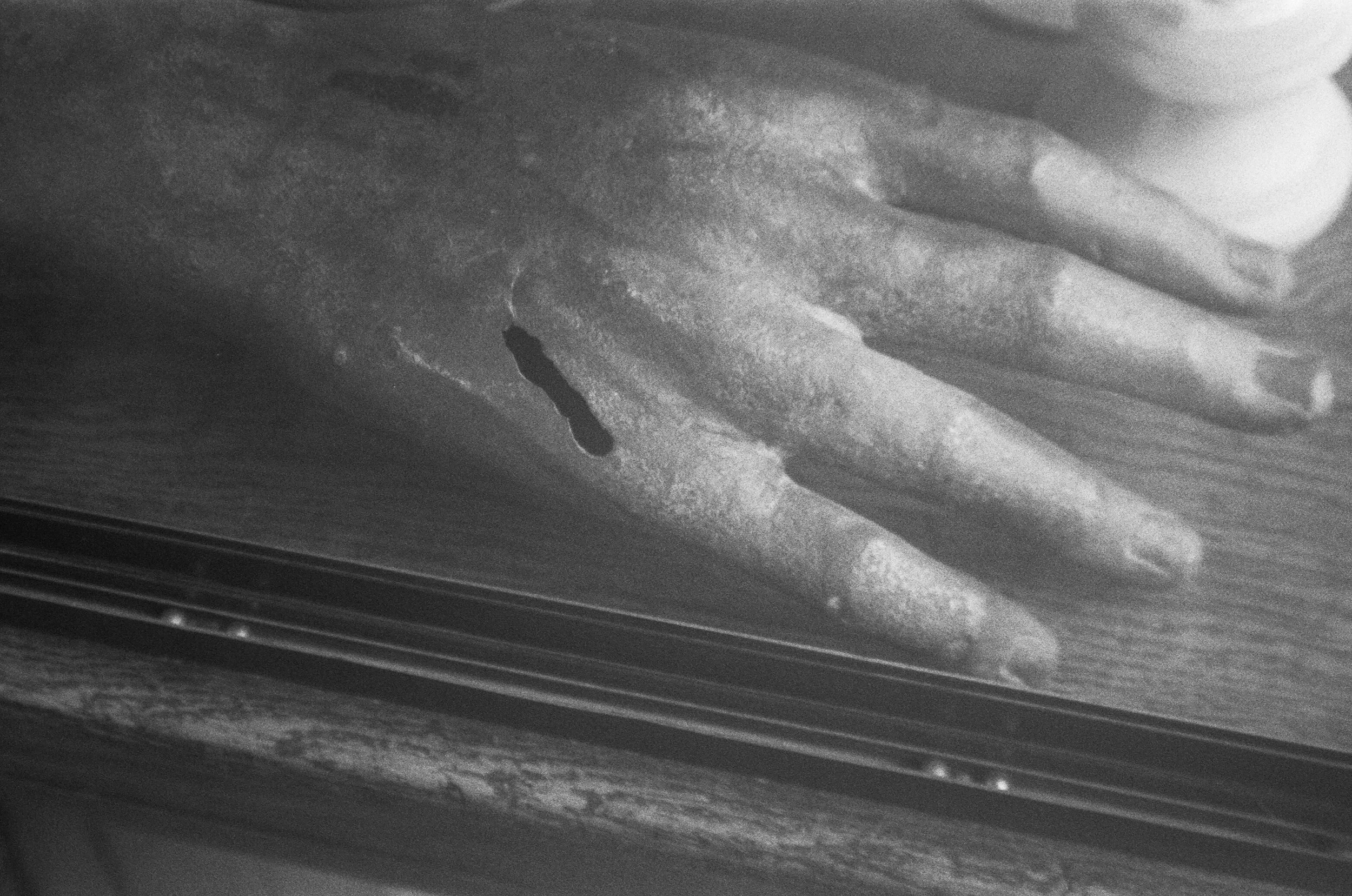 Trichiasis「倒睫」 