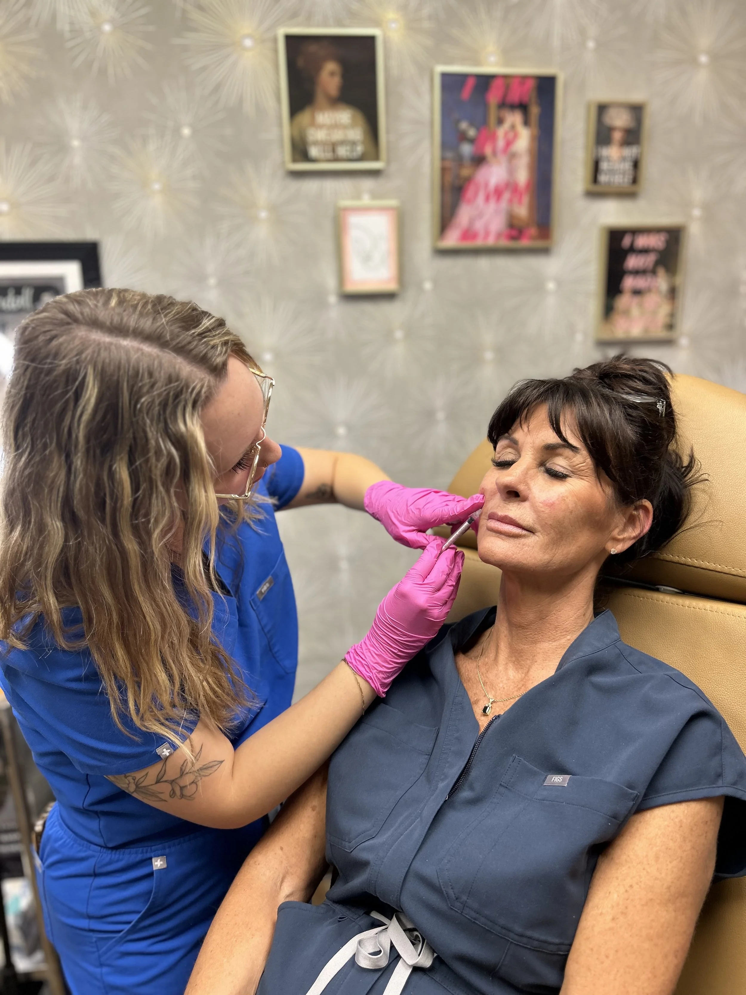 Marionette Line Filler