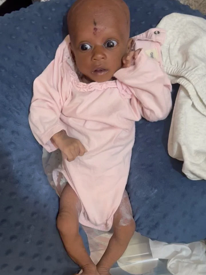 Aisha lost her twin at 20 days old and was dangerously close to starvation when she arrived at our clinic at 34 days old. Her mother struggled to breastfeed her due to low supply and there were no funds for formula. She had heard about a free clinic 