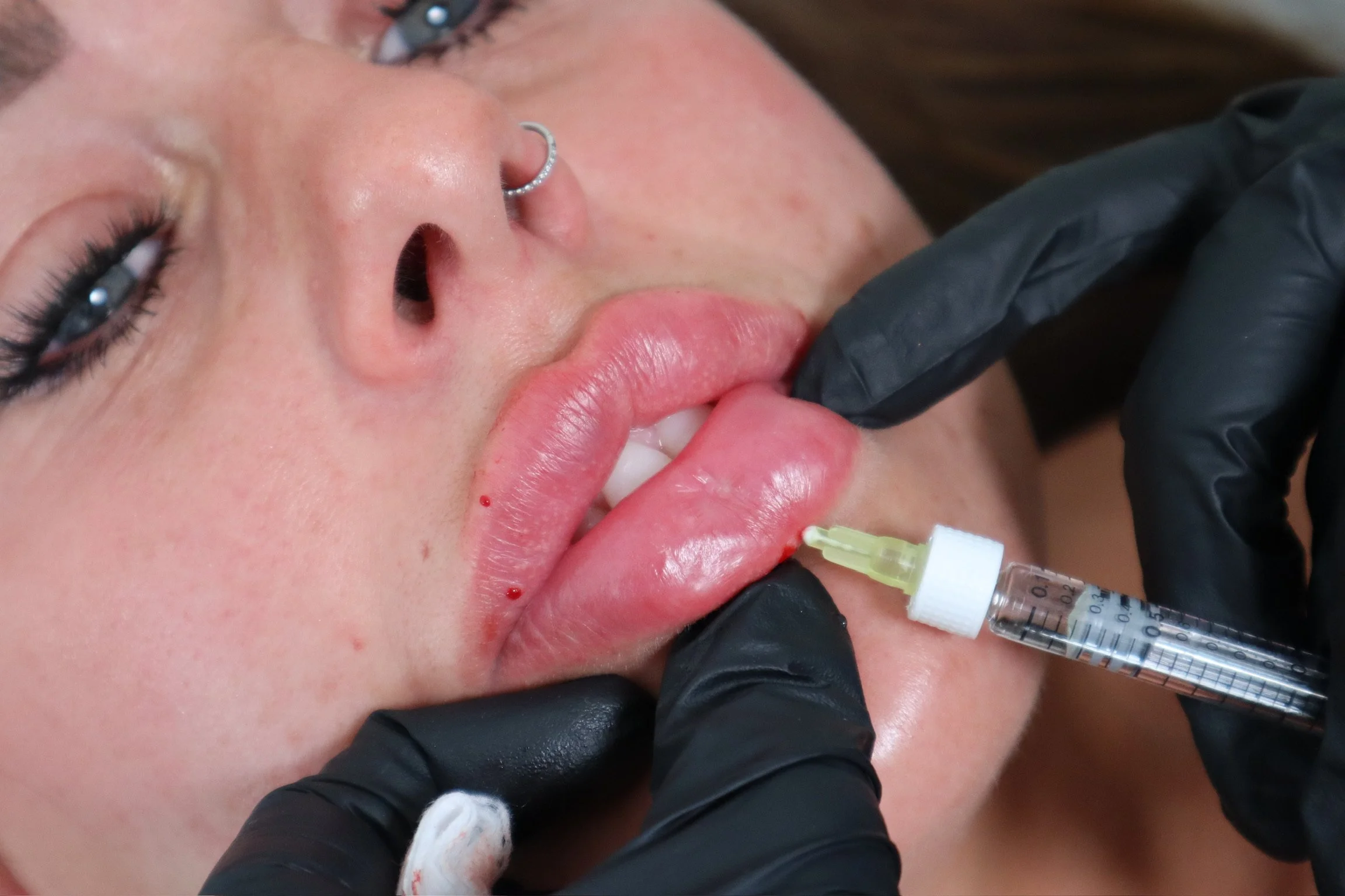 lip%2Bfiller%2Bmaidstone%2Bkent.png