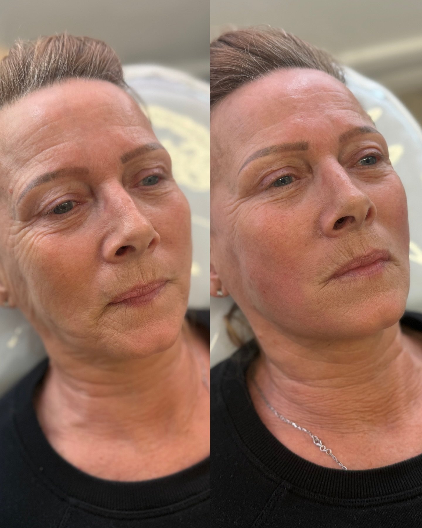 Refined, natural results ✨

A beautifully softened jawline and lifted appearance using our Endo Fibre Lift 💫

By focusing on the jowls alone, we&rsquo;ve created a noticeably firmer, more contoured look enhancing our clients natural features without