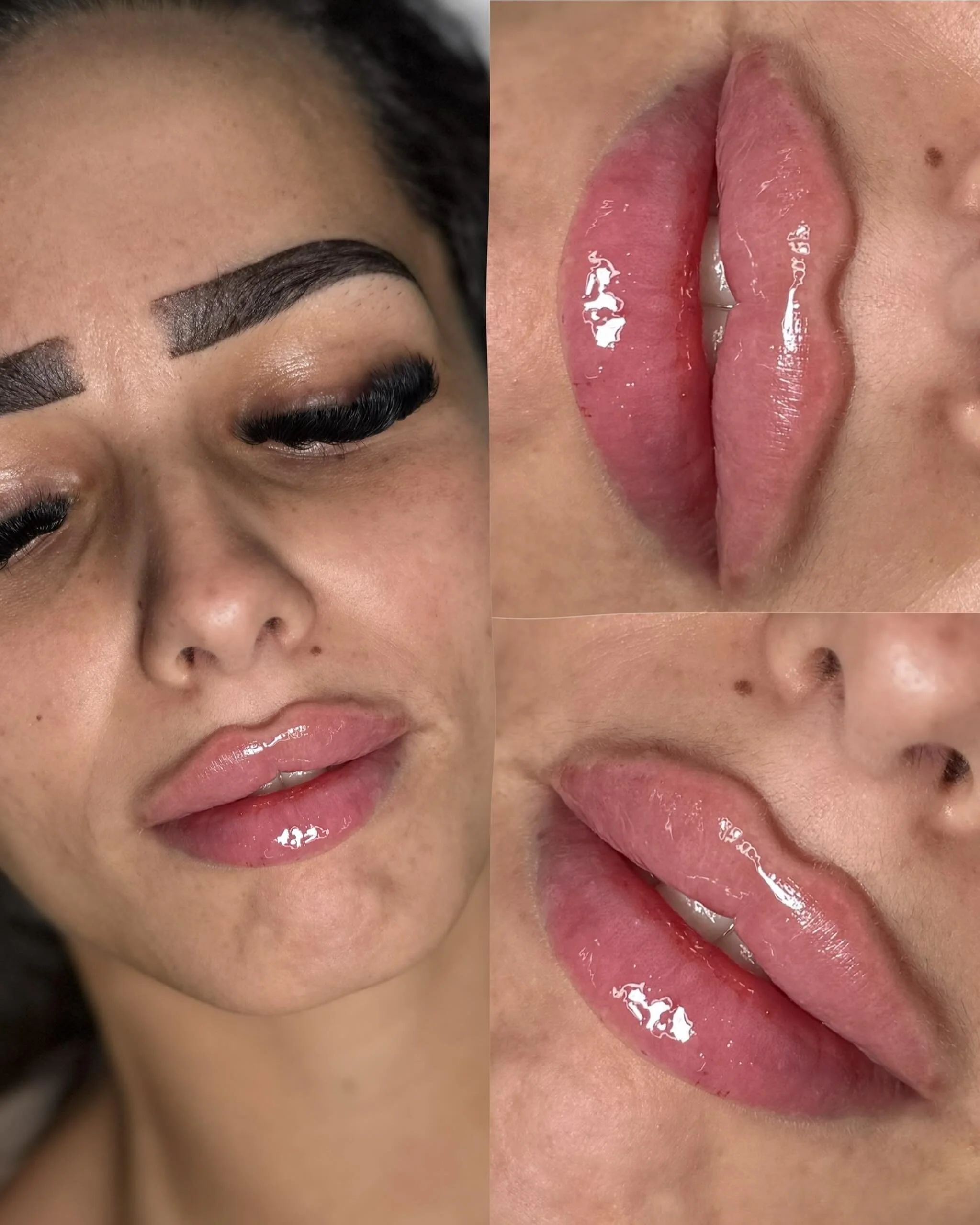 That Cupid&rsquo;s bow&hellip; absolutely unreal ☁️✨

The shape, the softness, the balance, everything about these lips complements her face so beautifully!

This is exactly why technique matters so much with lip filler&hellip;

Creating lips like th