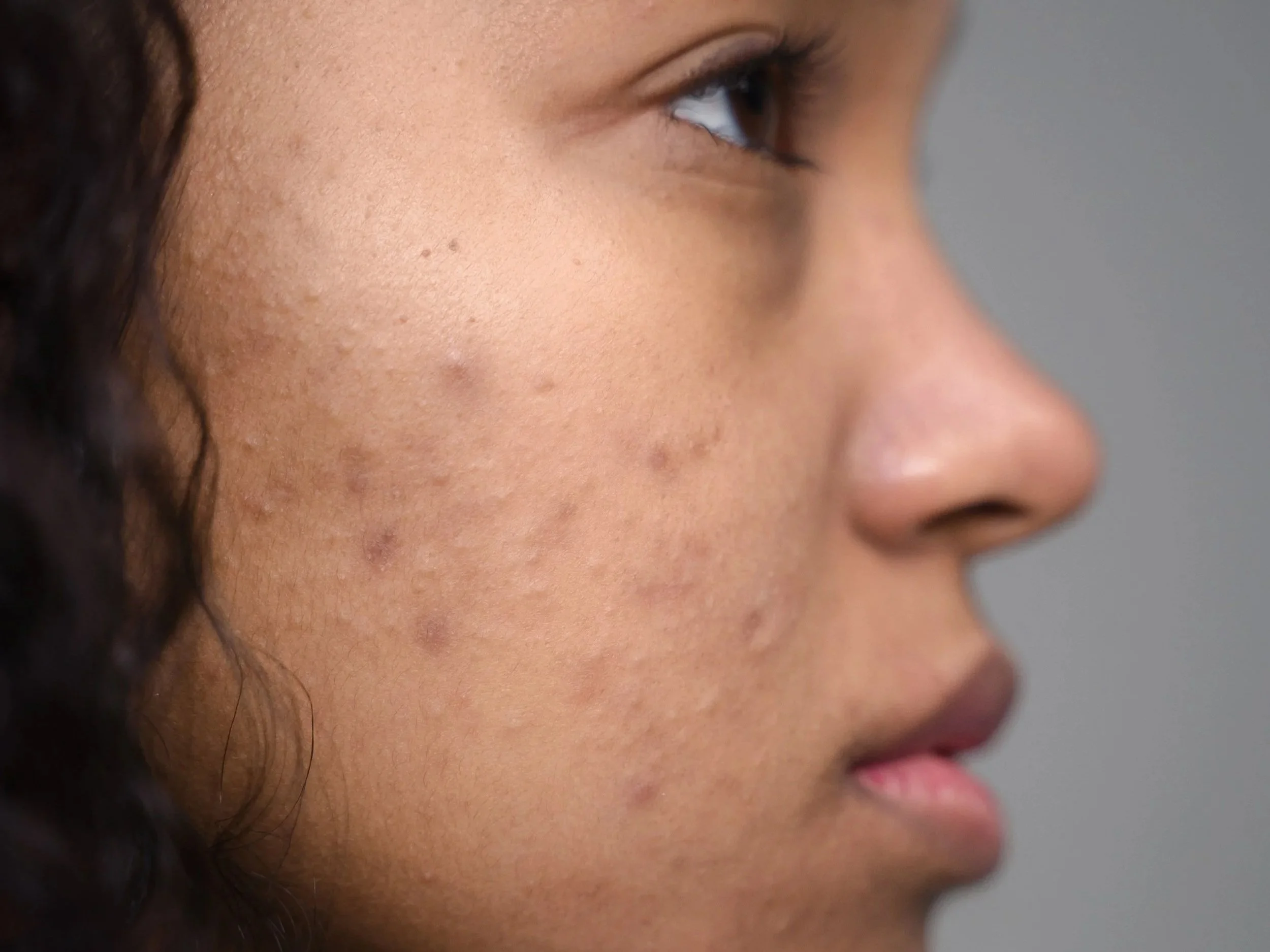 How to Fade Acne Scars: What Actually Works for Red and Brown Marks (PIE &amp; PIH Explained)