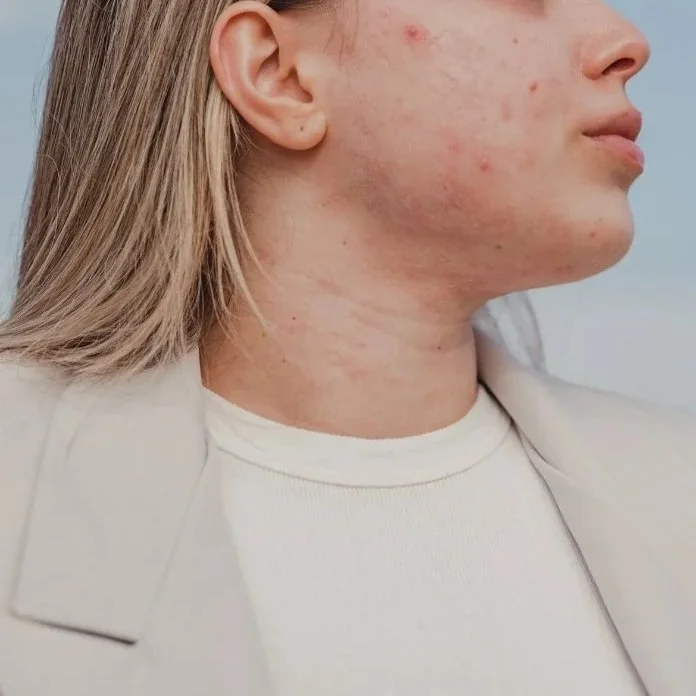 Why You've Tried Everything and Your Skin Still Isn't Clearing