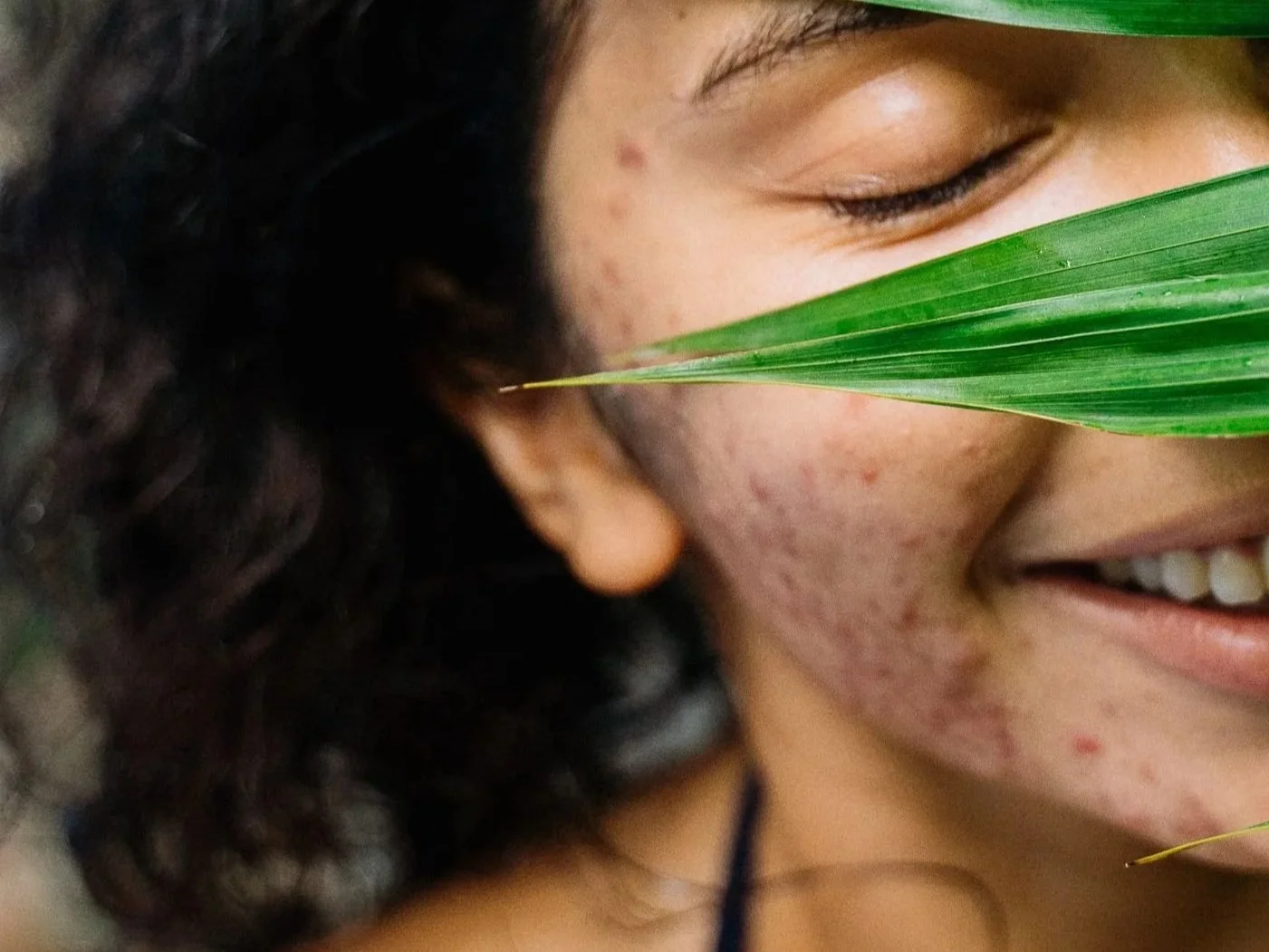 Bad Bacteria on the Skin Aren’t the Enemy: Why Barrier Health Matters More Than Killing "Bad Bacteria"