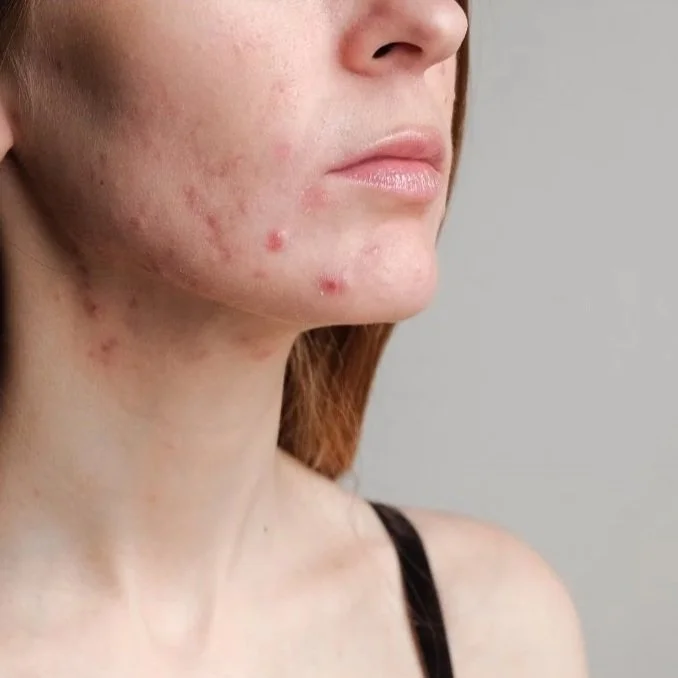 Is Your Acne Hormonal? (And Why the Answer Might Surprise You)