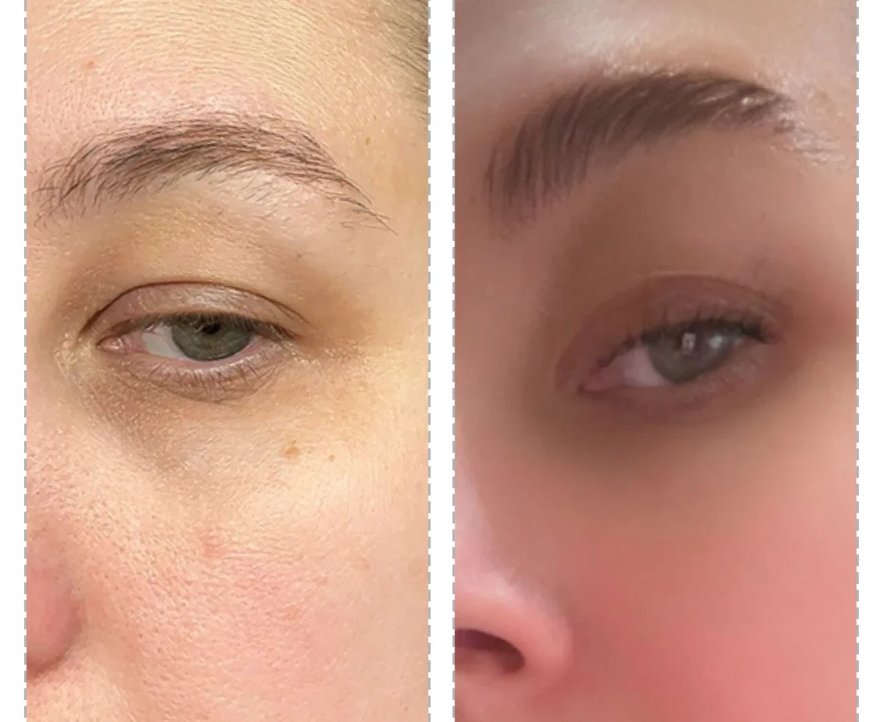 Side-by-side comparison of a person's face showing improvement in skin condition, with the left side depicting skin with uneven texture and dark circles, and the right side showing smoother, clearer skin with less visible dark circles.