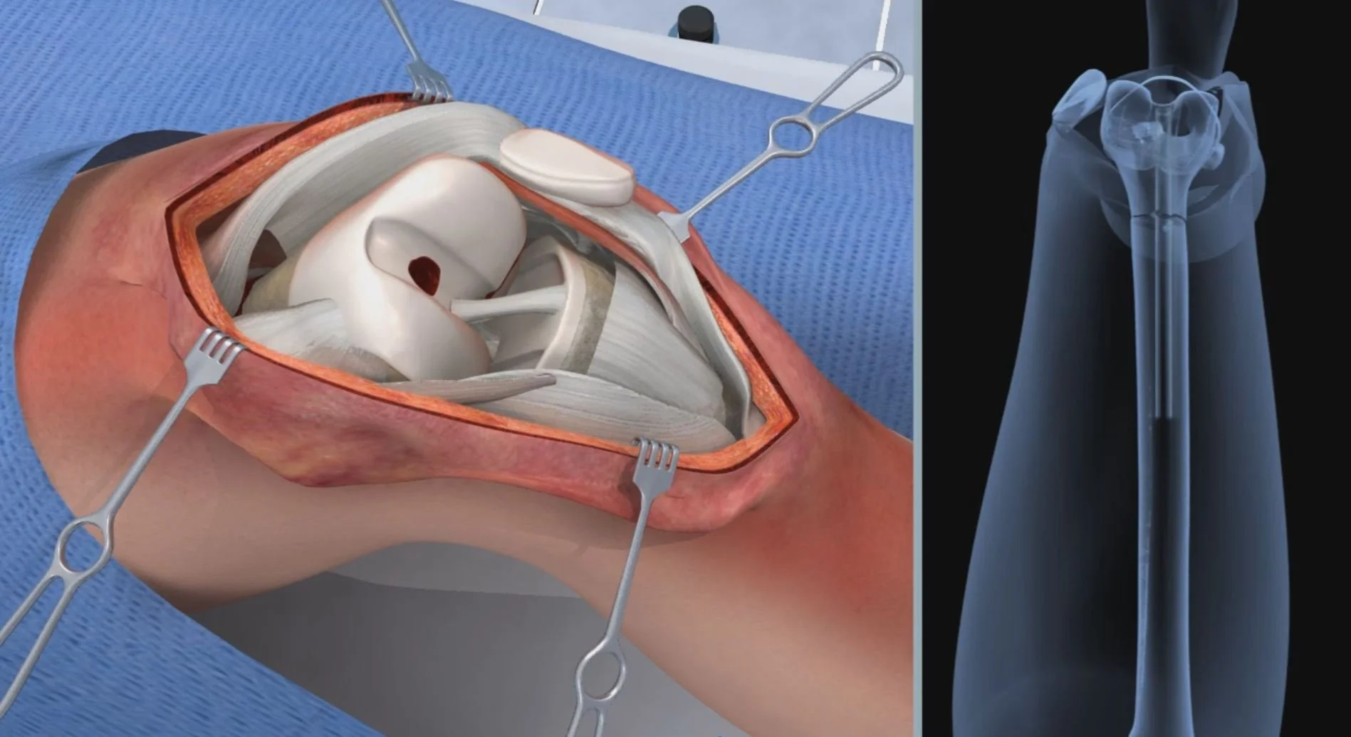 An illustration of shoulder surgery showing the shoulder joint with bones, muscles, and tendons, and surgical tools. The right side shows an X-ray view of the shoulder bones.