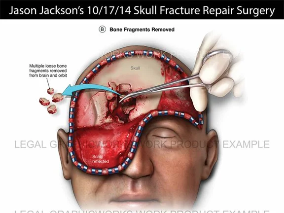 Illustration of skull fracture repair surgery showing removal of bone fragments from the skull and brain, with a focus on the skull, brain, and surgical tools.