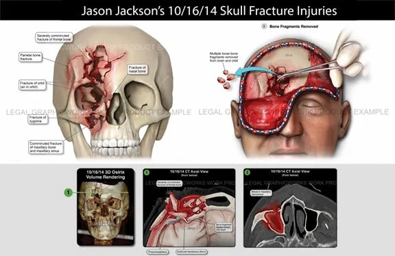 Diagram and scans showing Jason Jackson's skull fracture injuries from October 16, 2014. The top section illustrates a skull with multiple fractures, bone fragments removed, and a fractured orbital bone. The right side depicts a surgical procedure wi