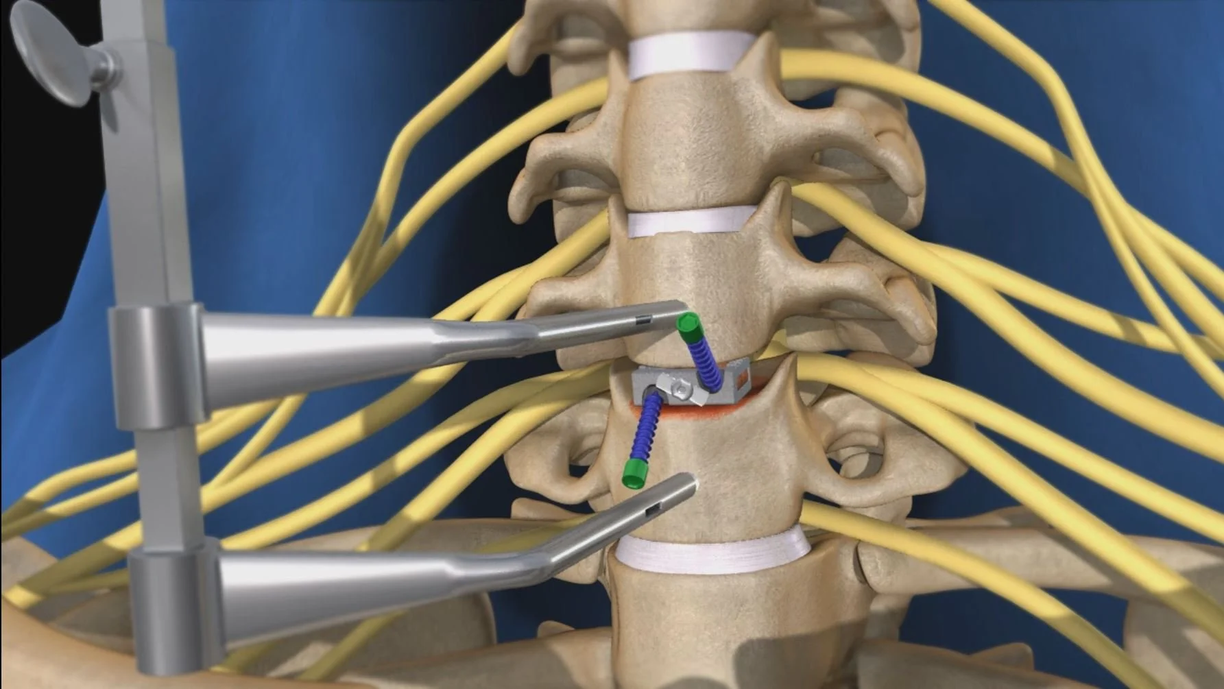 Medical model of a human spine showing vertebrae, nerves, and surgical instruments during spinal surgery.