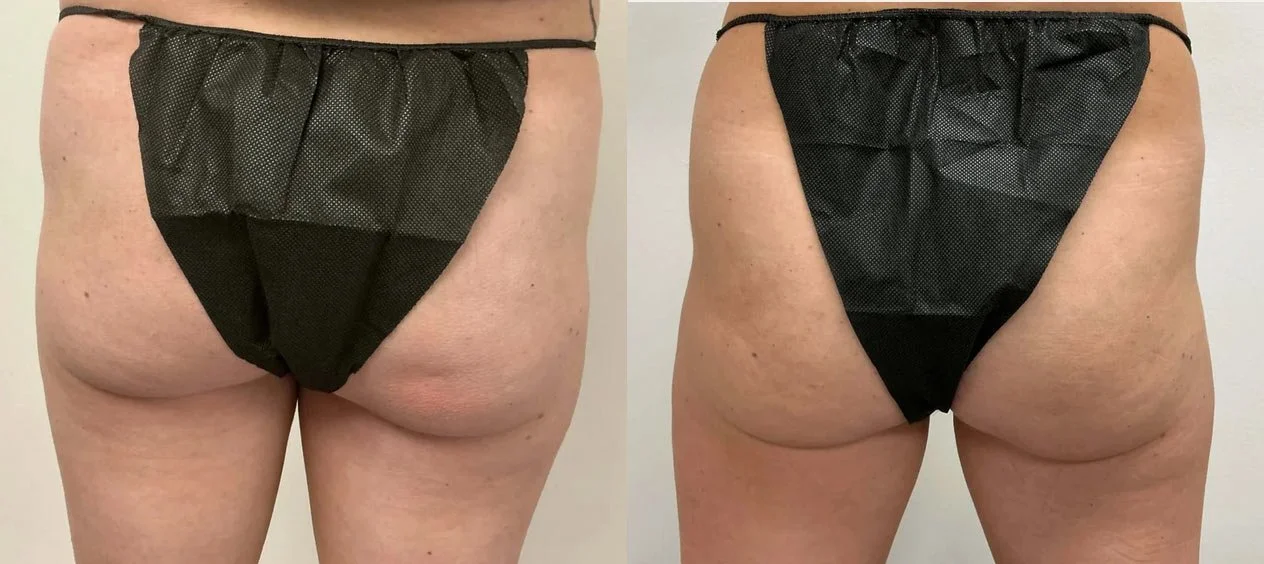 Aveli Cellulite Reduction