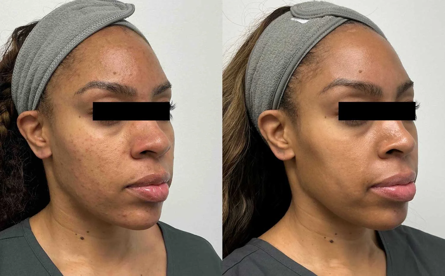 Acne, Brown Spot &amp; Pigment Laser