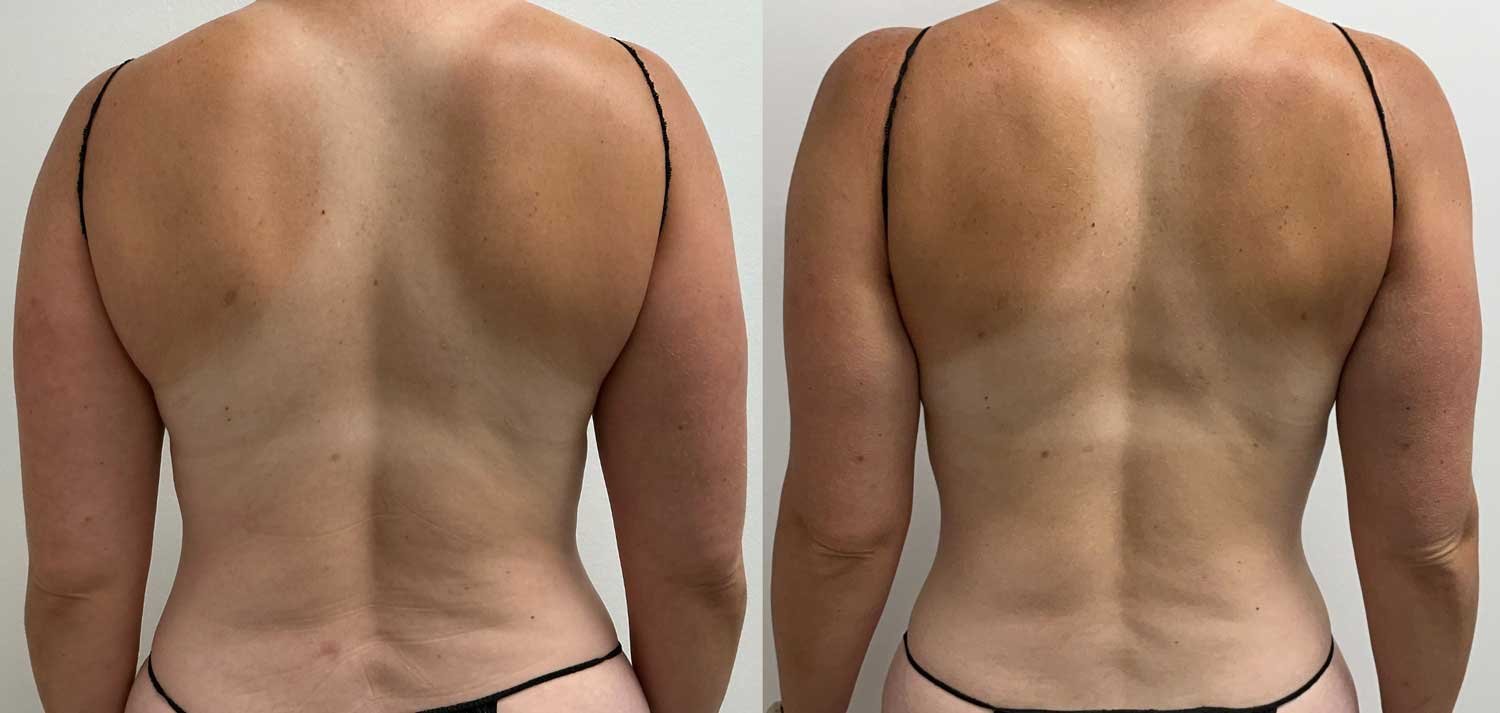 Unwanted Fat and Mini Liposuction