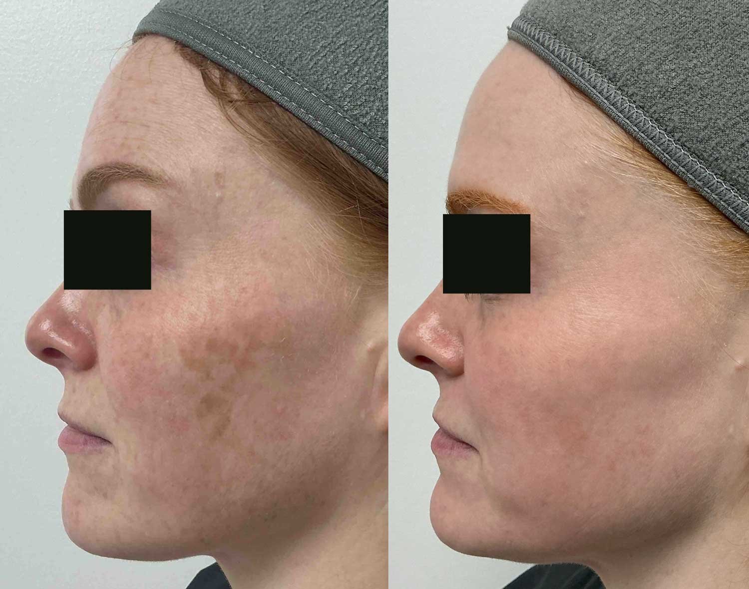 Sun Damage &amp; Brown Spot and Pigment Laser