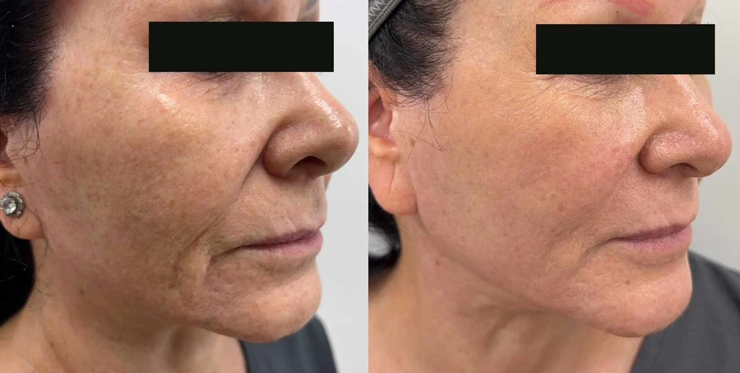 Sofwave, Pigment-Specific Laser, Skin Tightening