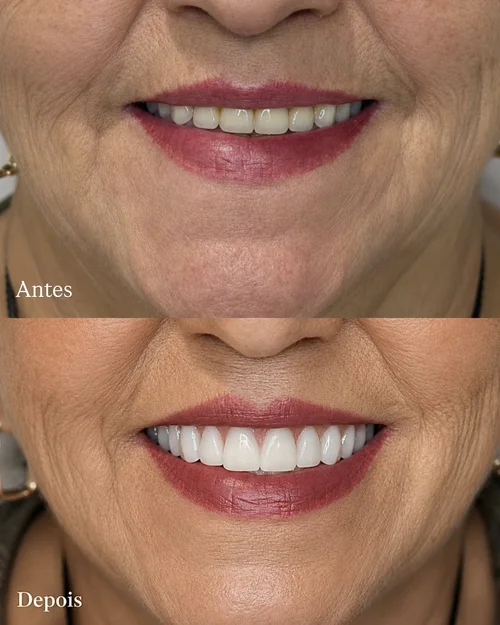Resultado de troca de prótese dentária — antes e depois