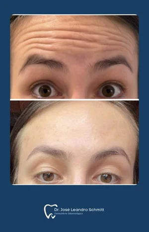 Botox - Procedimento de Harmonização Facial
