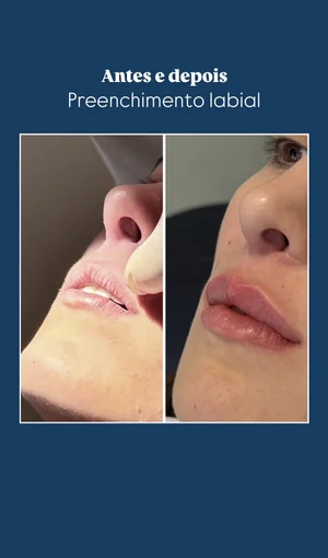 Preenchimento Labial - Antes e depois