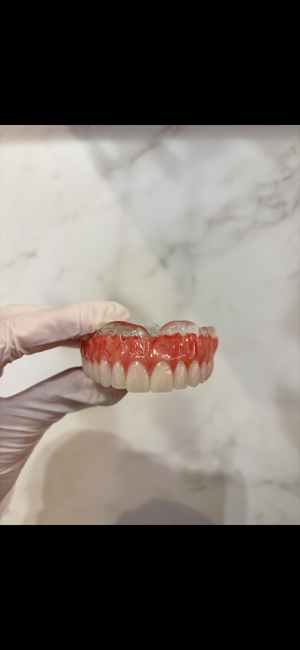 Prótese dentária personalizada - resultado natural e confortável